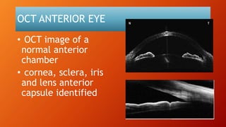 OCT ANTERIOR EYE
• OCT image of a
normal anterior
chamber
• cornea, sclera, iris
and lens anterior
capsule identified
 