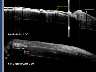 Vetbiosis sheets
                                                                          Corneal oedema



     324 µm




Vetbiosis Graft D0


               Conjunctiva     150 µm



               Corneal
               Stroma        320 µm




Conjunctival Graft D 30sans vetbiosi (légender les images
   Keratectomie avec et
    Greffe conjonctivale post-op et après retrait (2 images à légender)
 