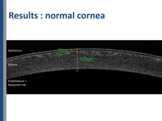 Results : normal cornea


Epithelium



Stroma




Endothelium +
Descemet mb
 