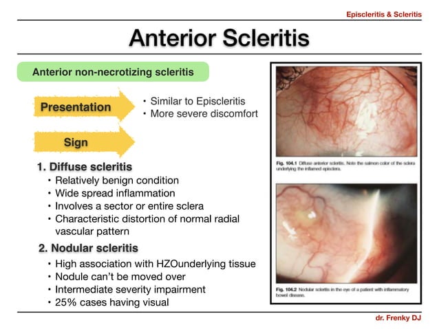 Episcleritis & Scleritis | PDF | Eye and Vision Conditions | Diseases ...