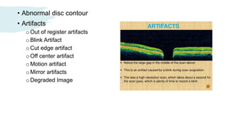 Oct Artefact Example Optical Coherence Tomography | PPTX