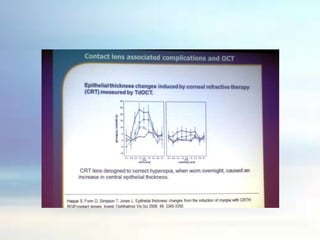 Var novērot radzenes sabiezējumu un mīksto kontaktlēcu plānināšanos.