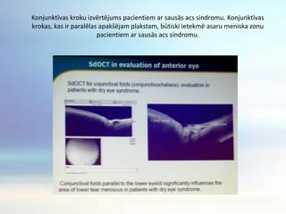 Kādas ir OCT nākotnes iespējas kontaktlēcu praksē?SSOCT tehnoloģijas iespējas nākotnē ir iespēja veikt kvalitatīvu radzenes analīzi un iegūt priekšējo un aizmugurējo acs struktūru attēlus. Visi šie dati ir daudz precīzāki un gūs sasniegumus kontaktoloģijā, it īpaši sarežģītākos un radzenes patoloģiju gadījumos.