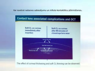Vai OCT var noteikt kontaktlēcas kustības uz radzenes?OCT ļauj veikt mērījumus laika posmā, līdz ar to ir iespējams novērtēt kontaktlēcas kustības gan kvalitātes, gan kvantitātes ziņā. OCT piemērots arī cieto k/l izvērtēšanai.