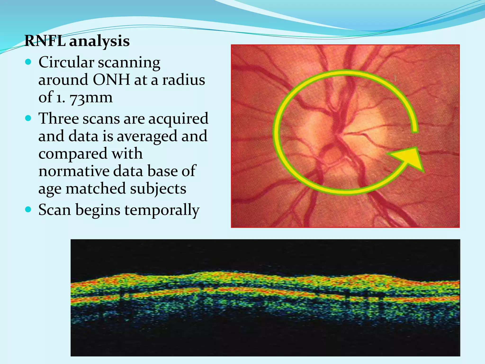 Oct in glaucoma | PPTX