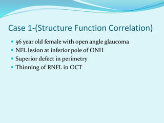 Case 3-(Unilateral Open Angle Glaucoma) 
 54 year old female 
 Unilateral exfoliative glaucoma 
 IOP- 33 mmHg 
 Thinni...
