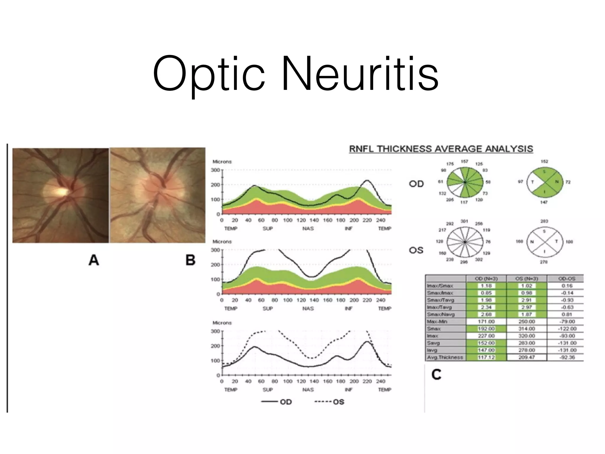 Optic Neuritis 
 