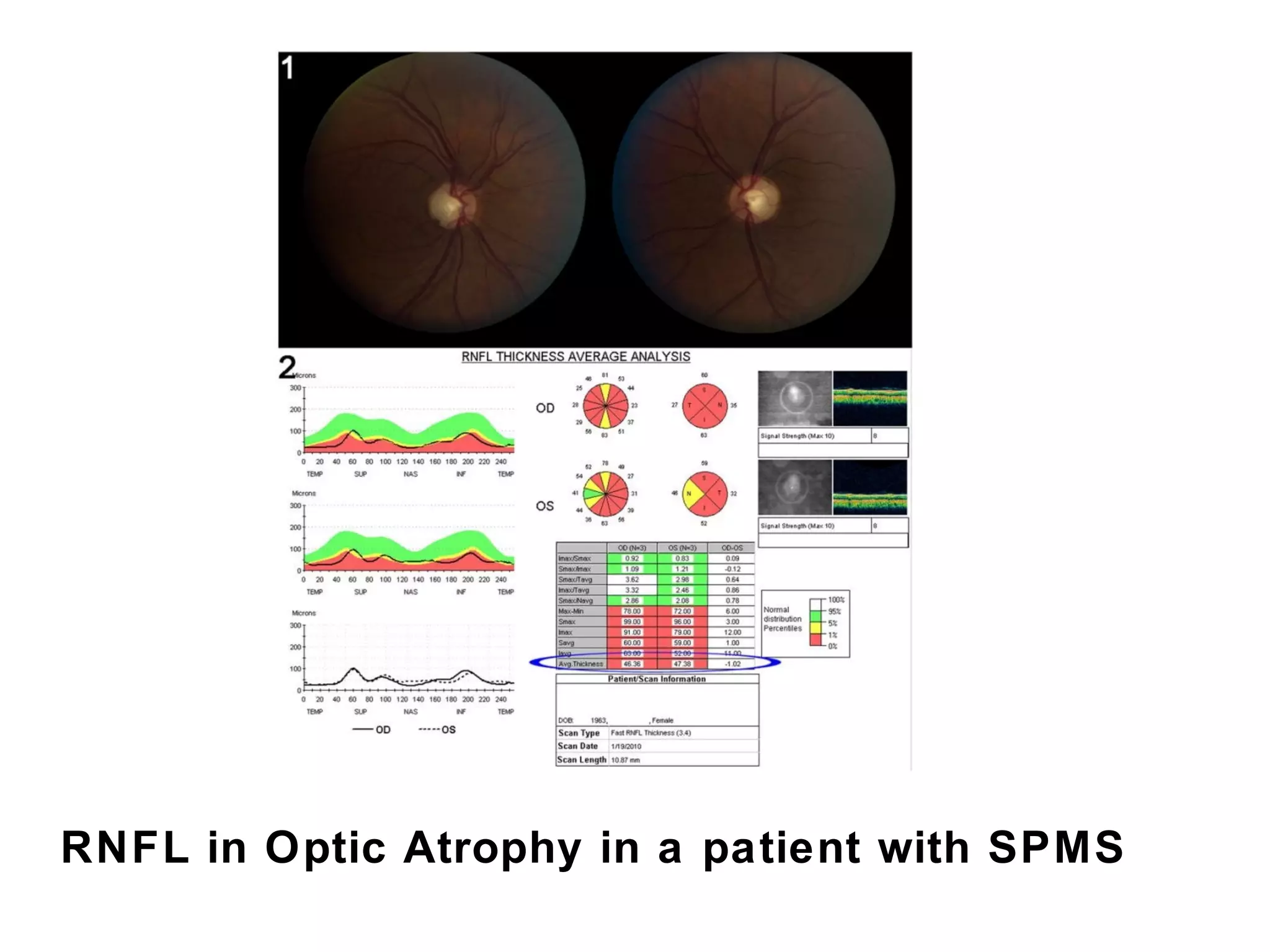 RNFL in Optic Atrophy in a patient with SPMS 
 