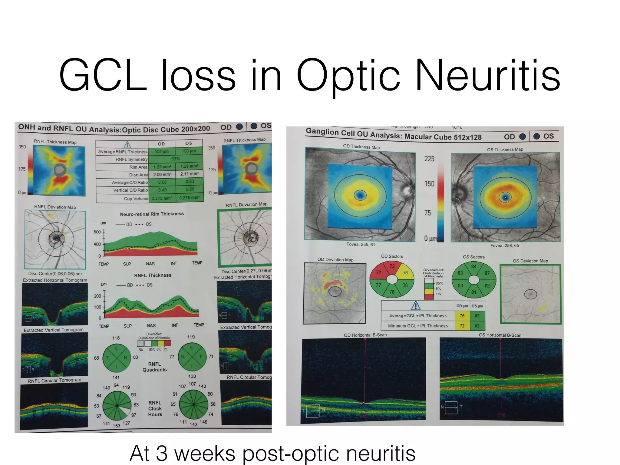GCL loss in Optic Neuritis 
At 3 weeks post-optic neuritis 
 