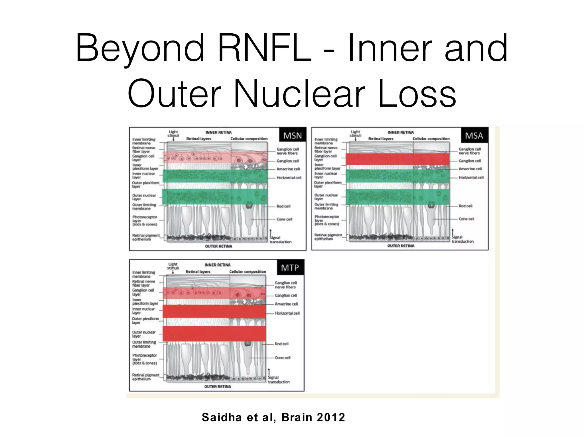 Beyond RNFL - Inner and 
Outer Nuclear Loss 
Saidha et al, Brain 2012 
 