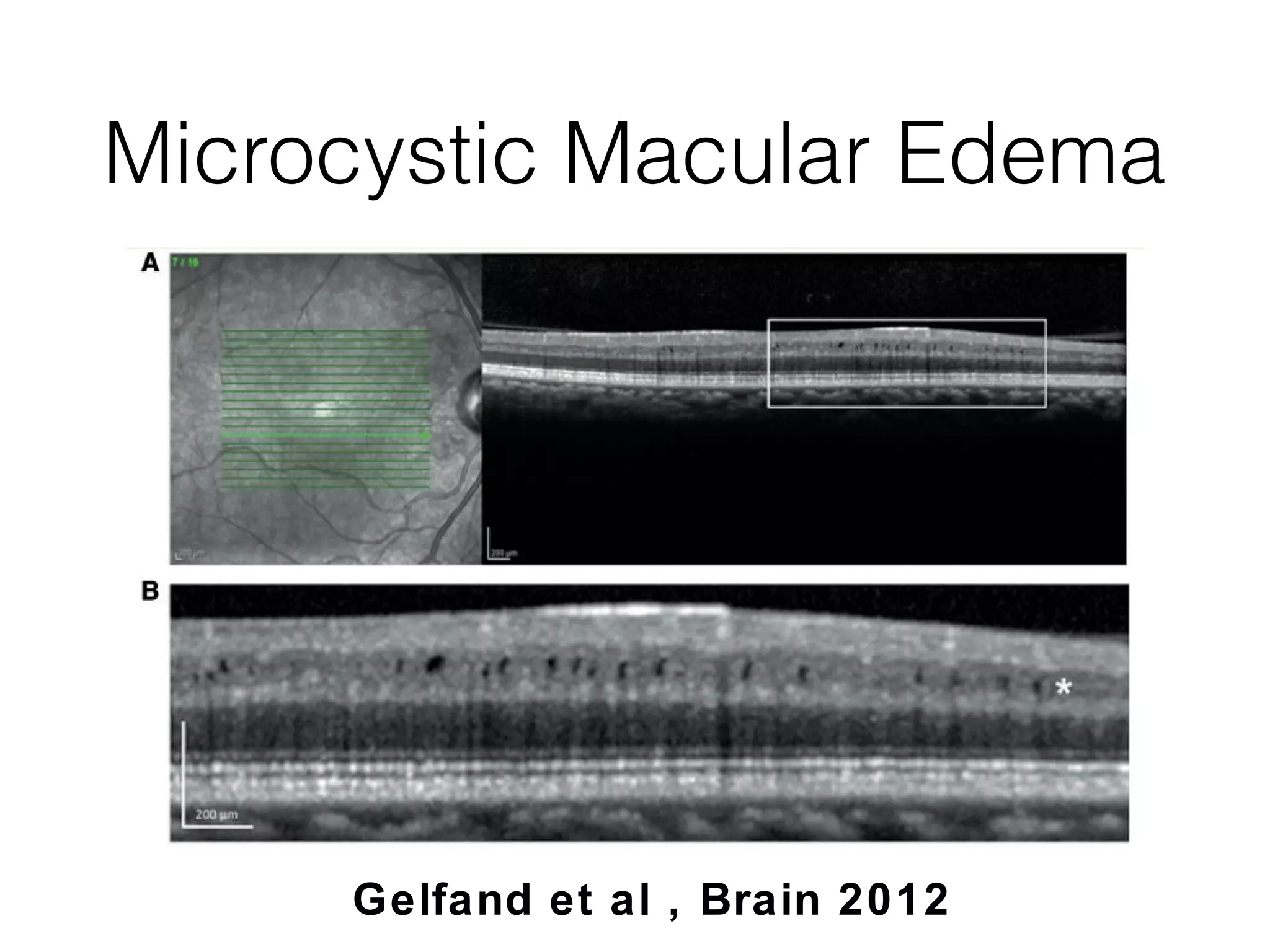 Microcystic Macular Edema 
Gelfand et al , Brain 2012 
 