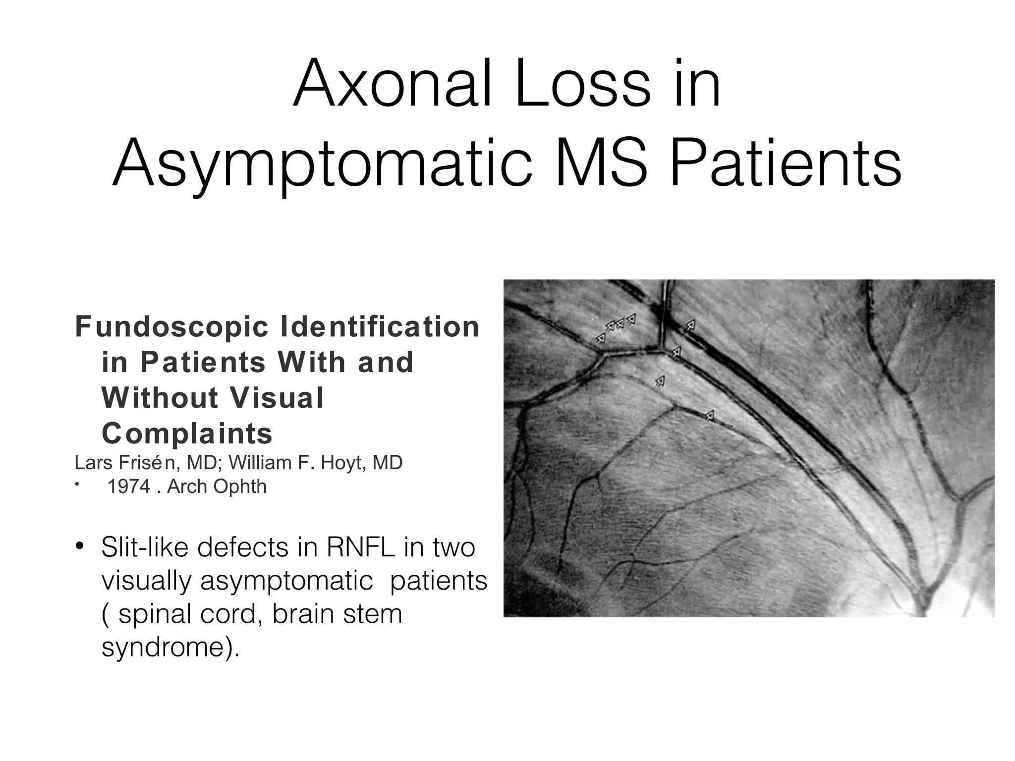 Axonal Loss in 
Asymptomatic MS Patients 
Fundoscopic Identification 
in Patients With and 
Without Visual 
Complaints 
Lars Frisén, MD; William F. Hoyt, MD 
• 1974 . Arch Ophth 
• Slit-like defects in RNFL in two 
visually asymptomatic patients 
( spinal cord, brain stem 
syndrome). 
 
