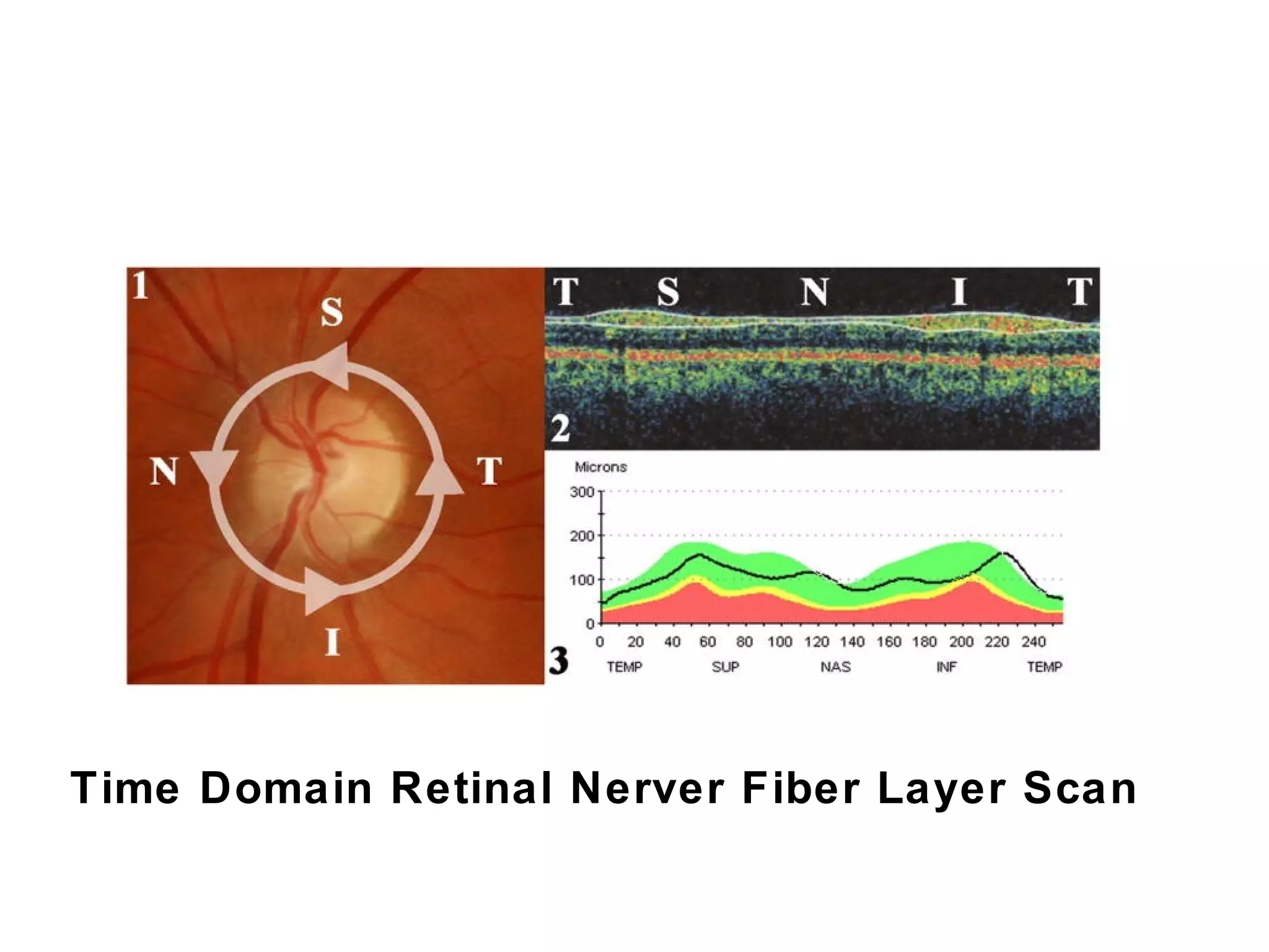 Time Domain Retinal Nerver Fiber Layer Scan 
 