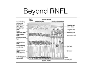 Beyond RNFL- Inner and 
Outer Nuclear Loss 
• Subset of patients with predominantly macular 
thinning and near normal RNFL...