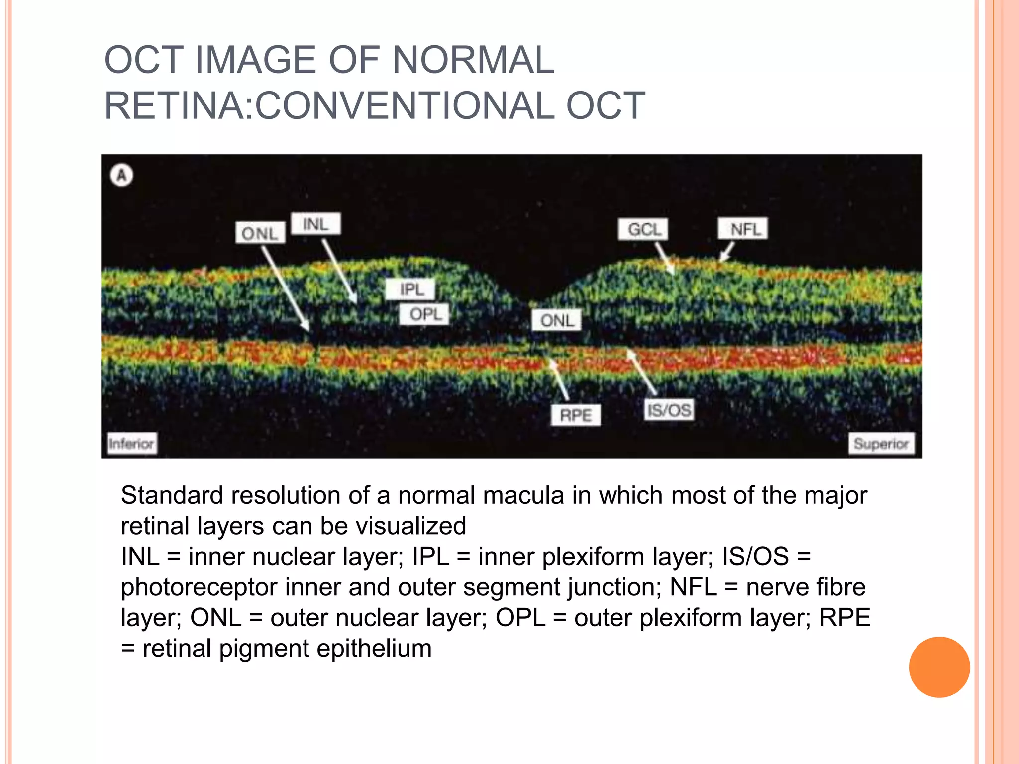 OCT IMAGE OF NORMAL
RETINA:CONVENTIONAL OCT
Standard resolution of a normal macula in which most of the major
retinal layers can be visualized
INL = inner nuclear layer; IPL = inner plexiform layer; IS/OS =
photoreceptor inner and outer segment junction; NFL = nerve fibre
layer; ONL = outer nuclear layer; OPL = outer plexiform layer; RPE
= retinal pigment epithelium
 