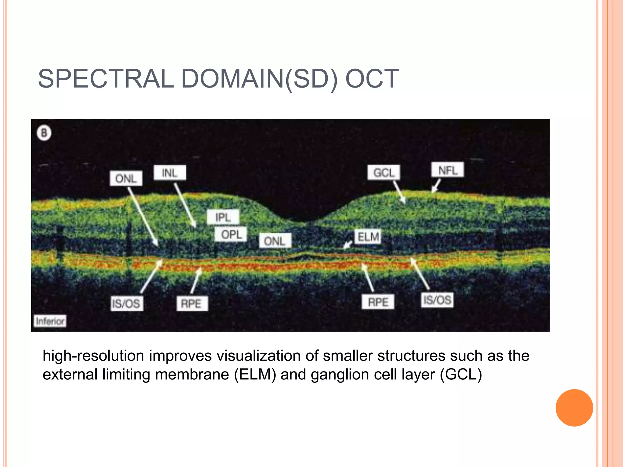 SPECTRAL DOMAIN(SD) OCT
high-resolution improves visualization of smaller structures such as the
external limiting membrane (ELM) and ganglion cell layer (GCL)
 
