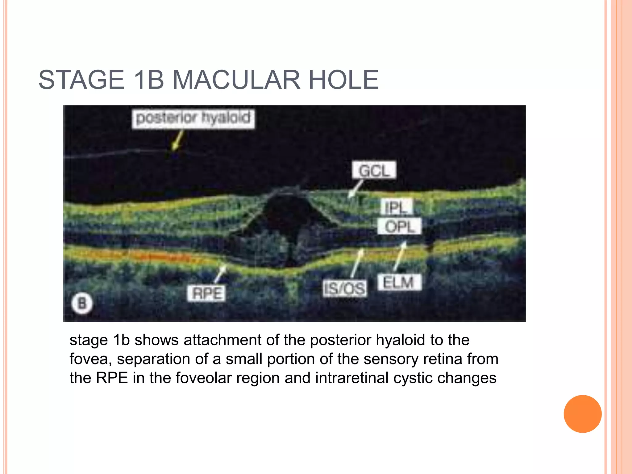 STAGE 1B MACULAR HOLE
stage 1b shows attachment of the posterior hyaloid to the
fovea, separation of a small portion of the sensory retina from
the RPE in the foveolar region and intraretinal cystic changes
 