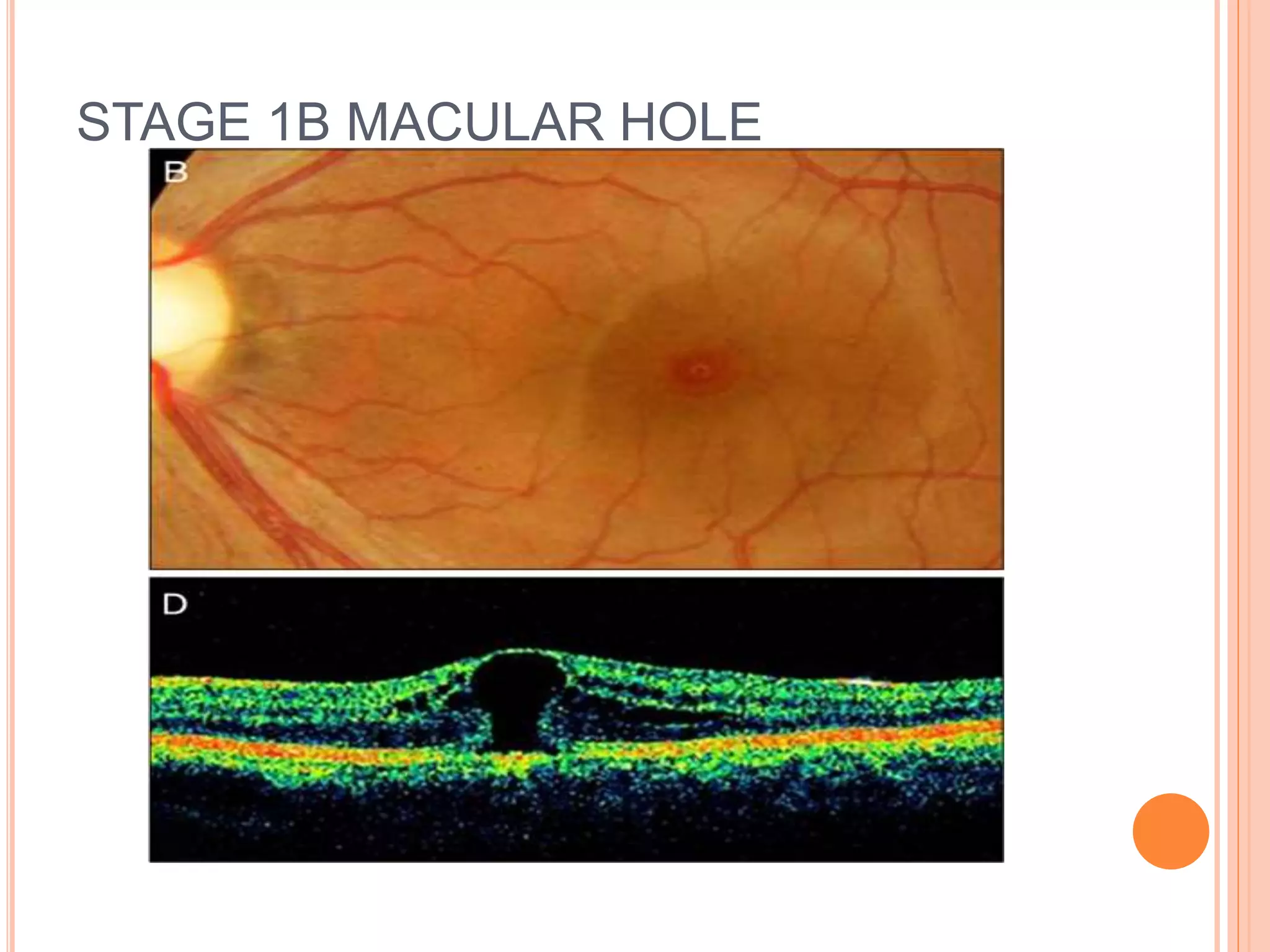 STAGE 1B MACULAR HOLE
 