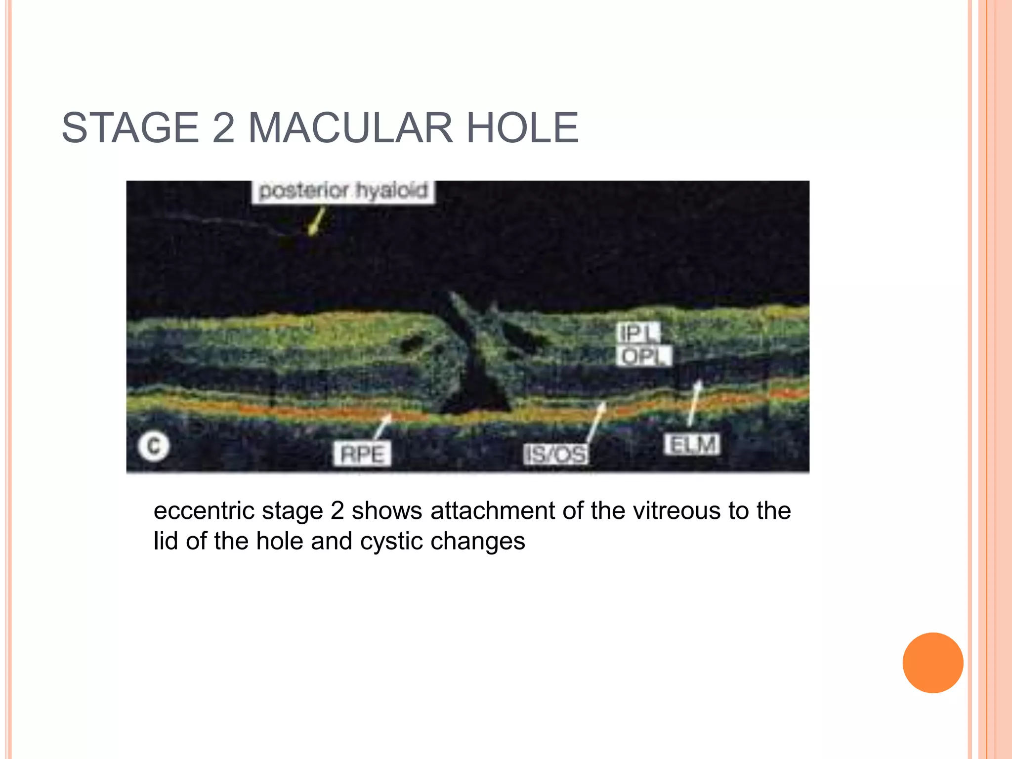 STAGE 2 MACULAR HOLE
eccentric stage 2 shows attachment of the vitreous to the
lid of the hole and cystic changes
 