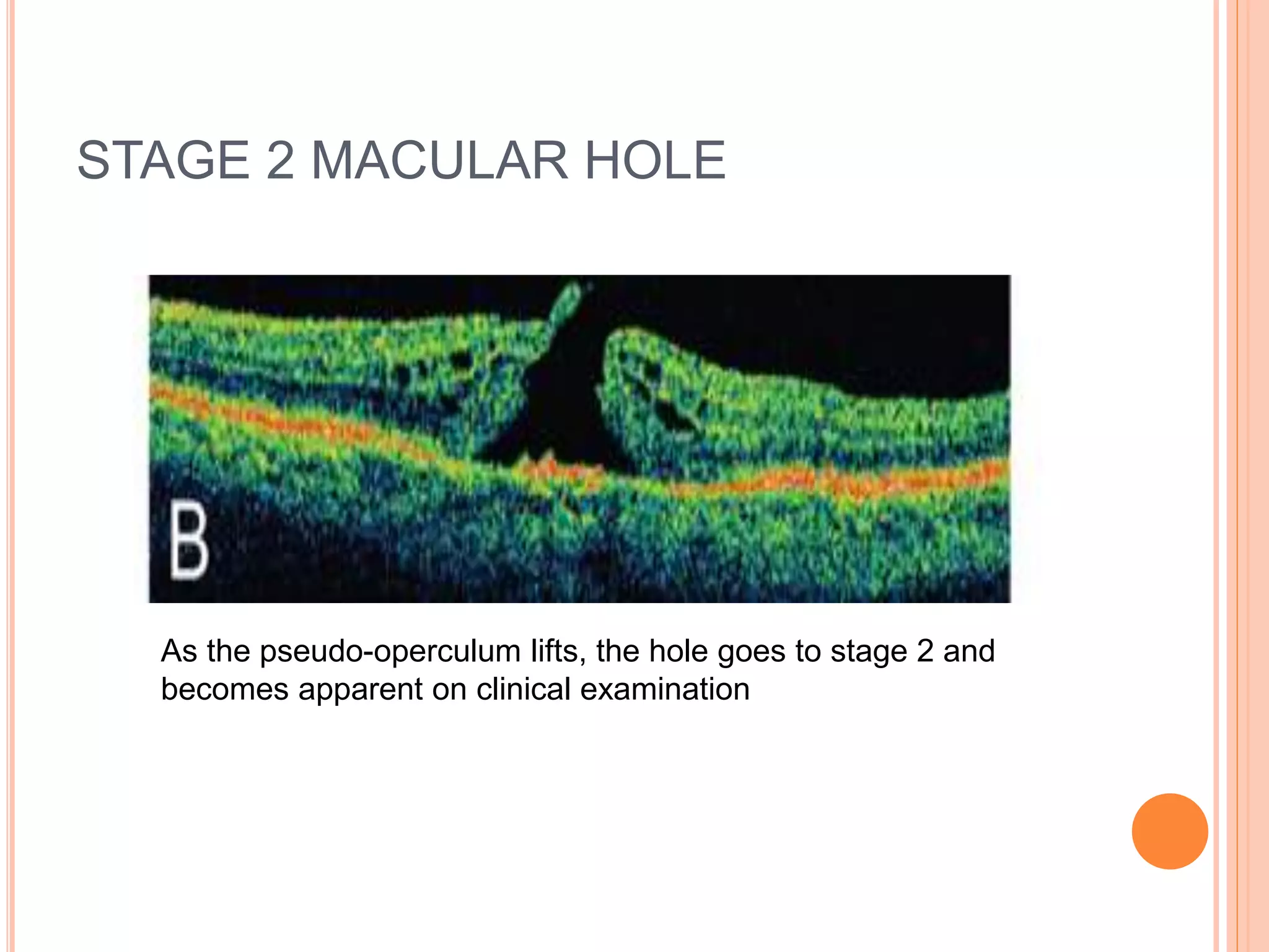 STAGE 2 MACULAR HOLE
As the pseudo-operculum lifts, the hole goes to stage 2 and
becomes apparent on clinical examination
 