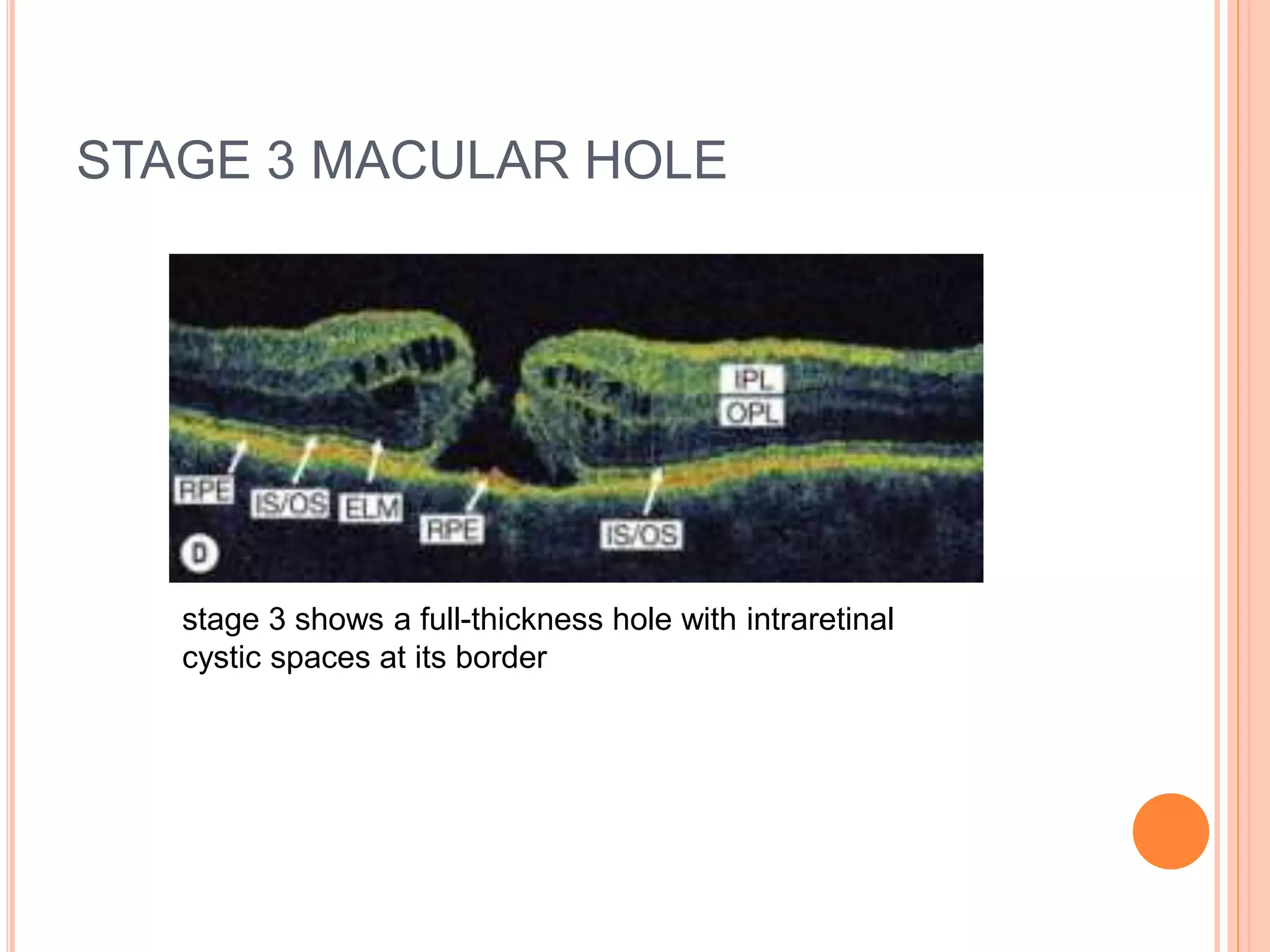 STAGE 3 MACULAR HOLE
stage 3 shows a full-thickness hole with intraretinal
cystic spaces at its border
 