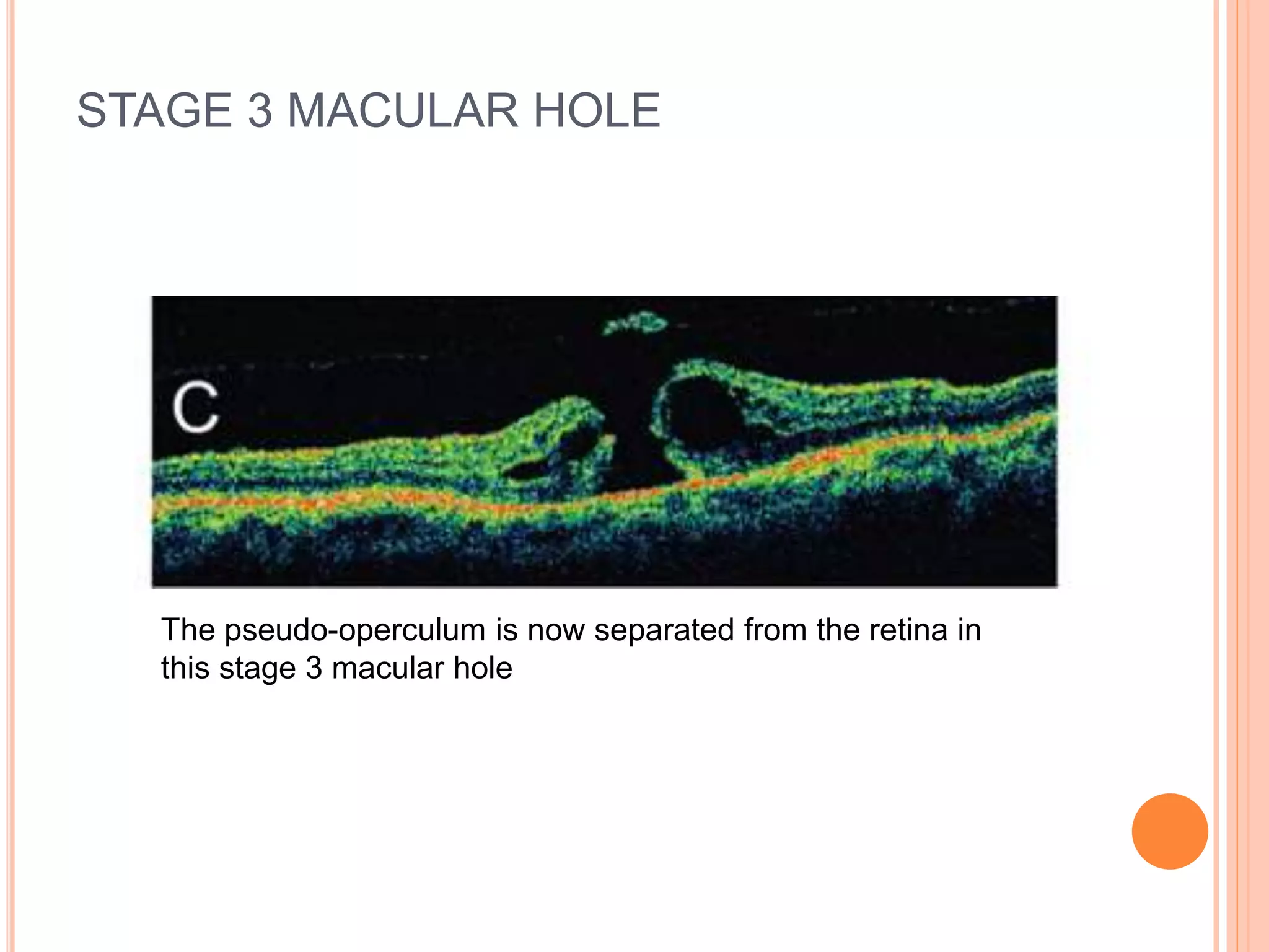 STAGE 3 MACULAR HOLE
The pseudo-operculum is now separated from the retina in
this stage 3 macular hole
 