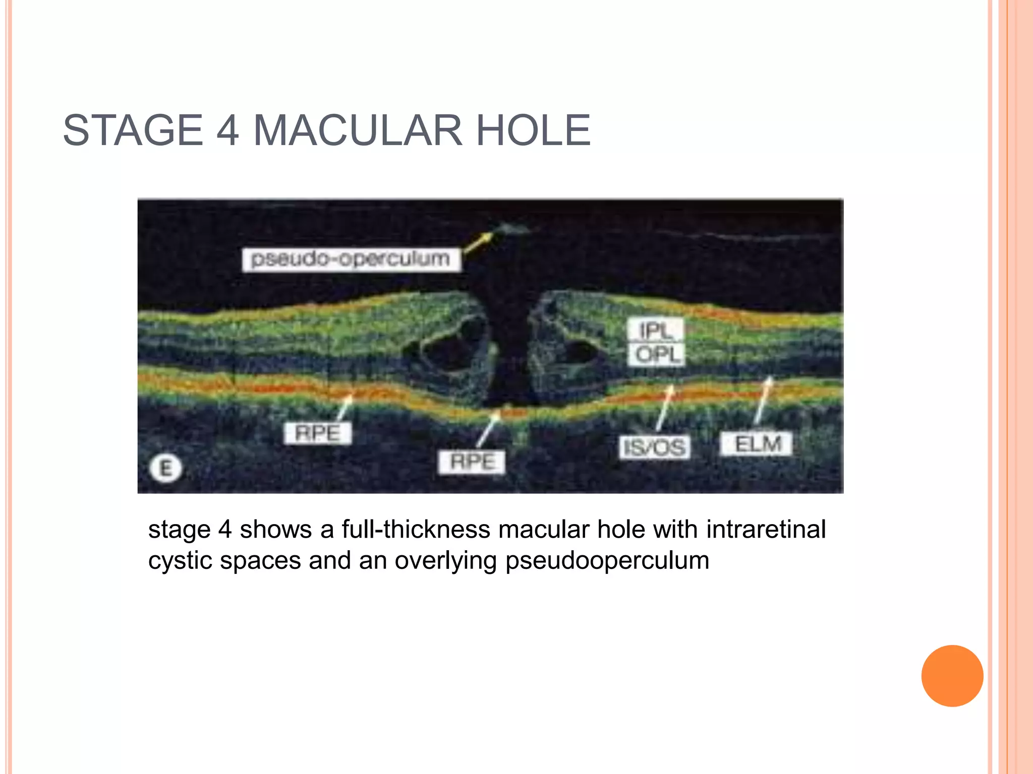 STAGE 4 MACULAR HOLE
stage 4 shows a full-thickness macular hole with intraretinal
cystic spaces and an overlying pseudooperculum
 