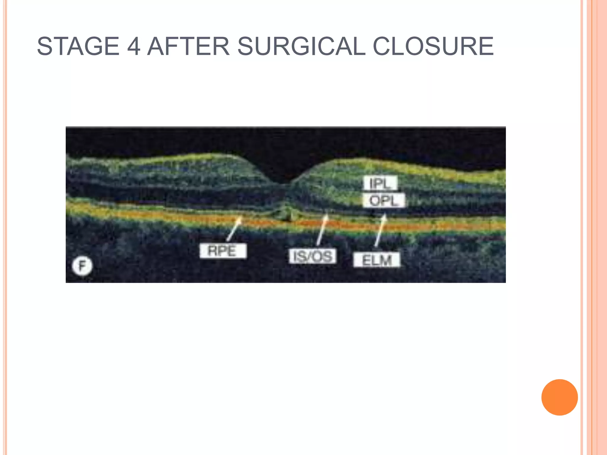 STAGE 4 AFTER SURGICAL CLOSURE
 