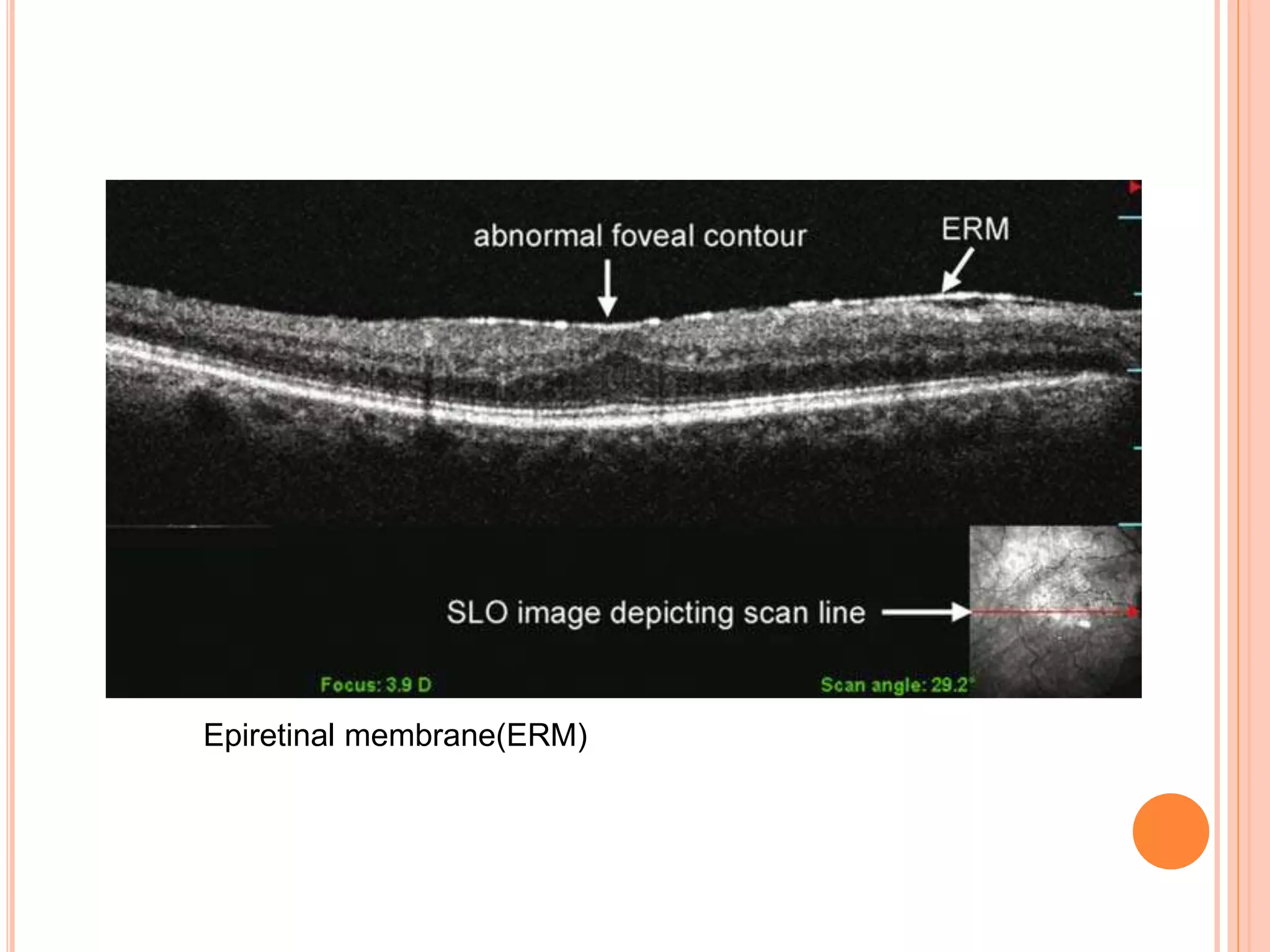 Epiretinal membrane(ERM)
 
