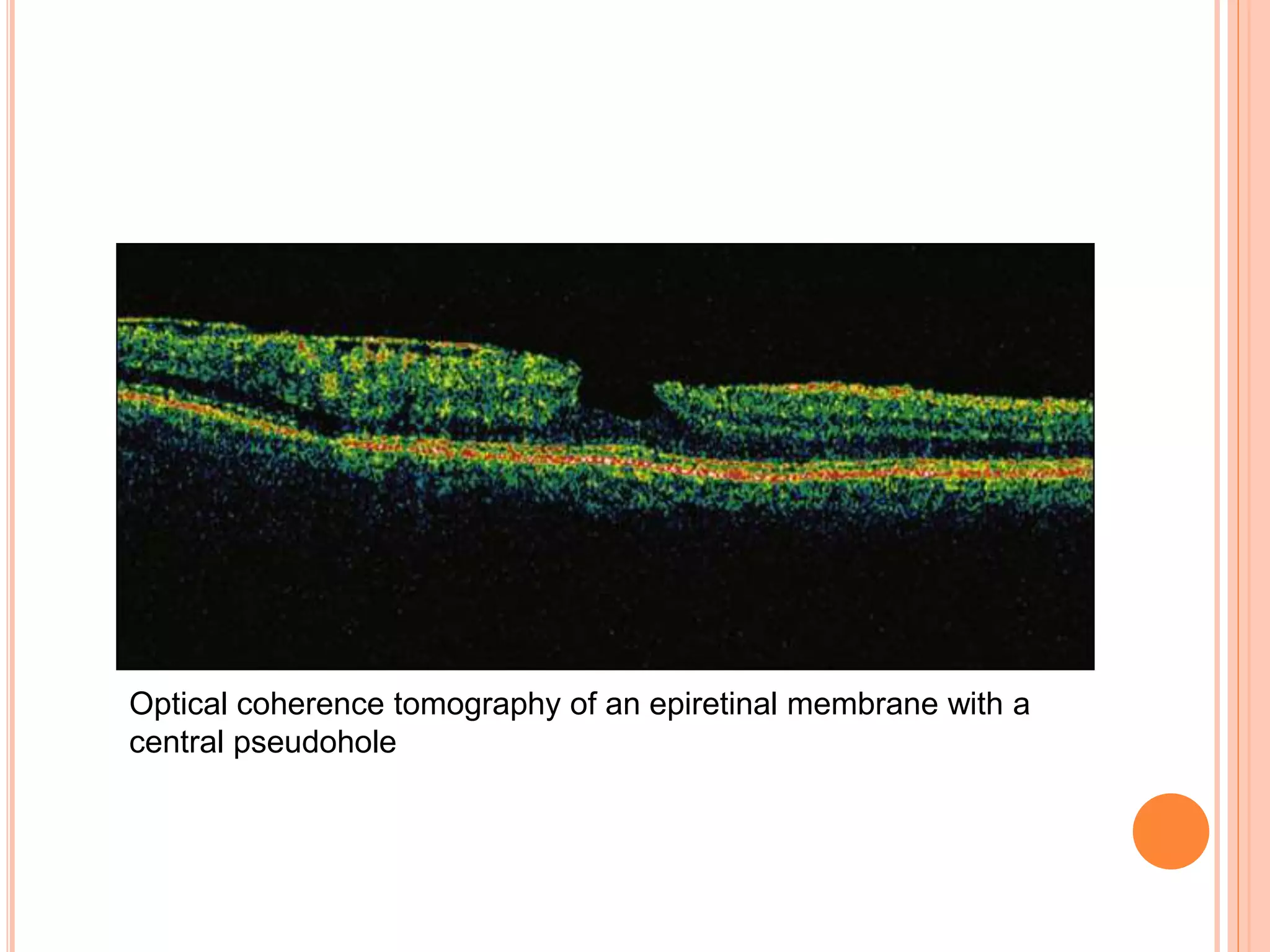 Optical coherence tomography of an epiretinal membrane with a
central pseudohole
 