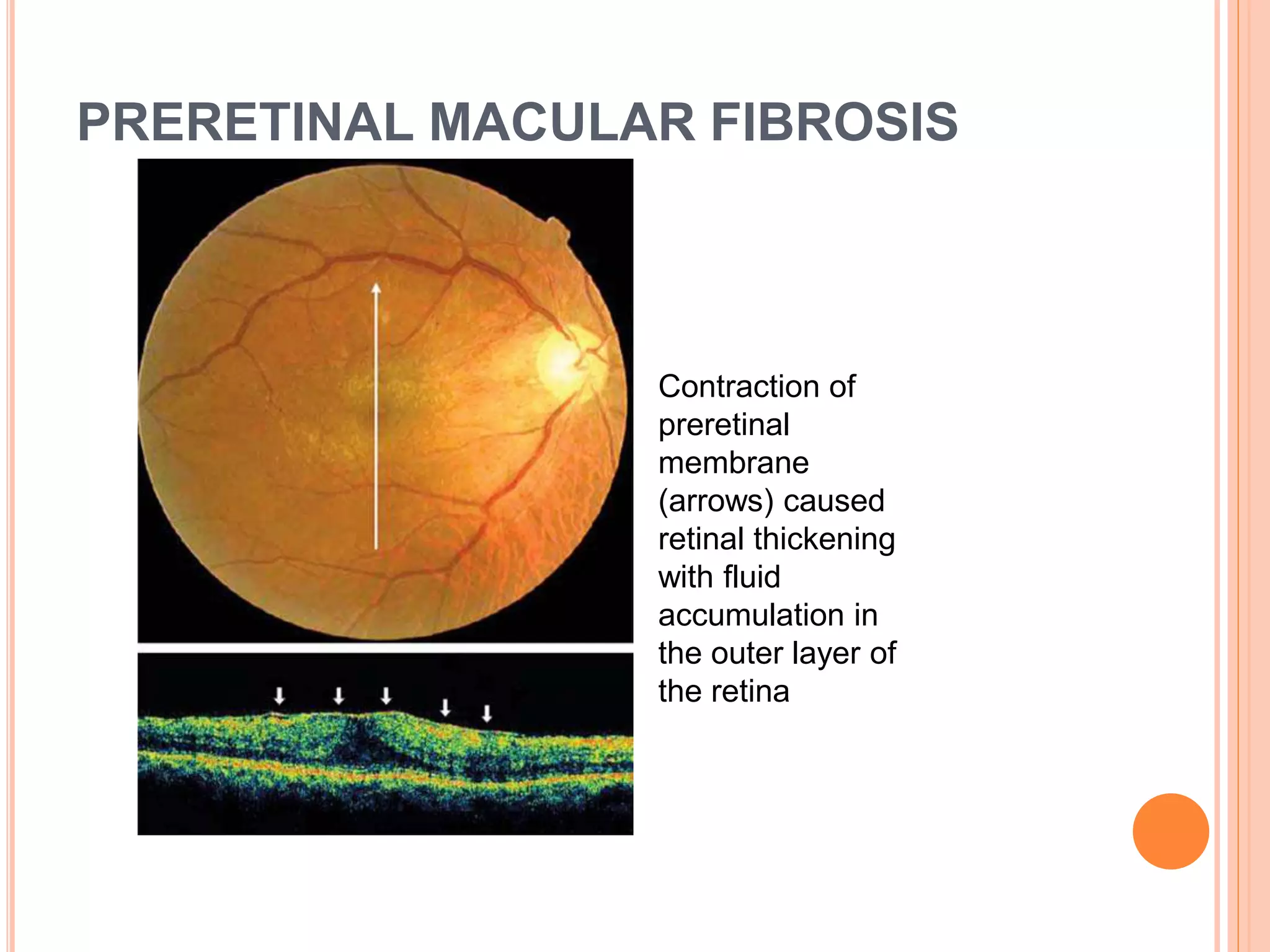 PRERETINAL MACULAR FIBROSIS
Contraction of
preretinal
membrane
(arrows) caused
retinal thickening
with fluid
accumulation in
the outer layer of
the retina
 