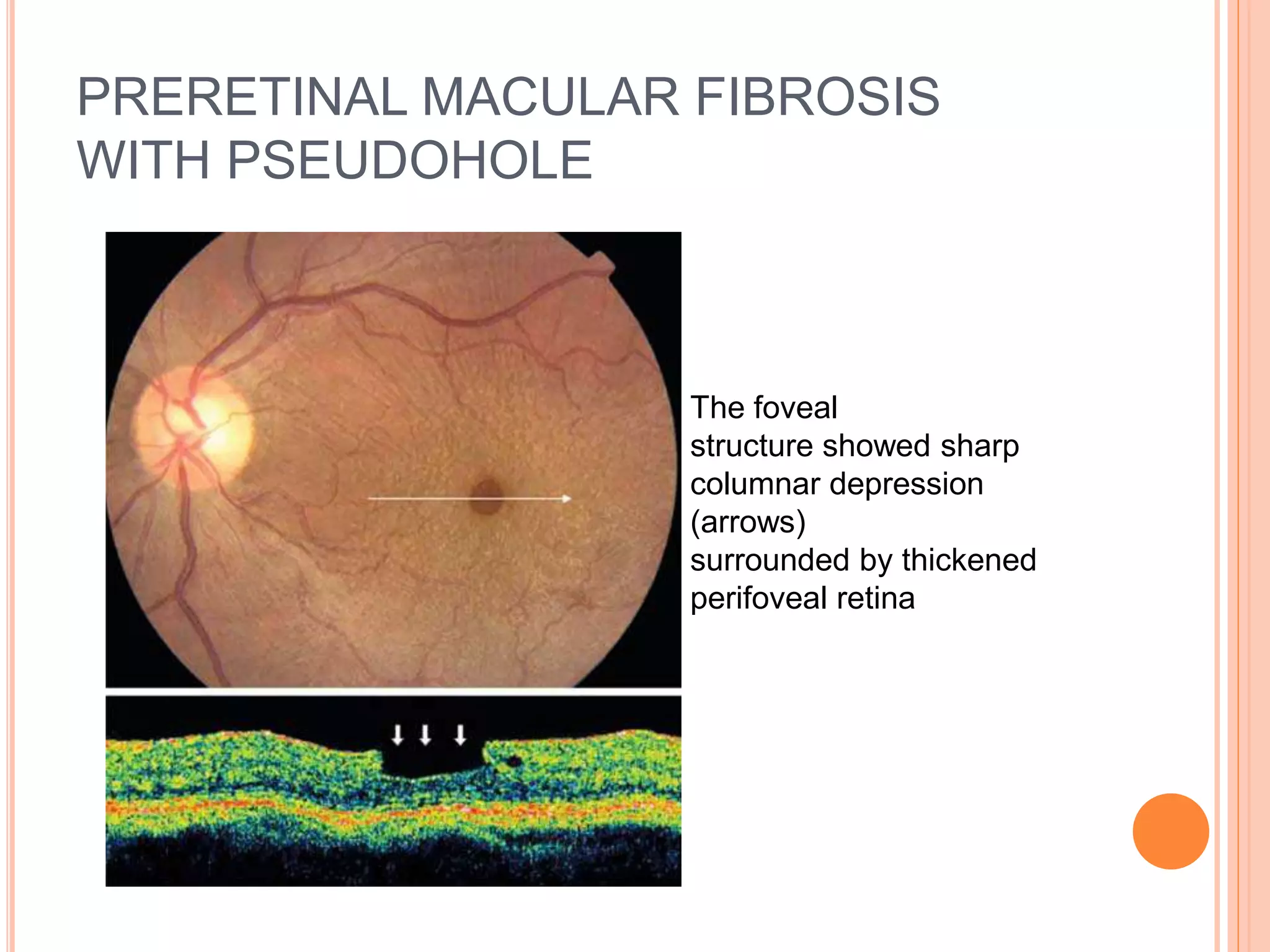 PRERETINAL MACULAR FIBROSIS
WITH PSEUDOHOLE
The foveal
structure showed sharp
columnar depression
(arrows)
surrounded by thickened
perifoveal retina
 