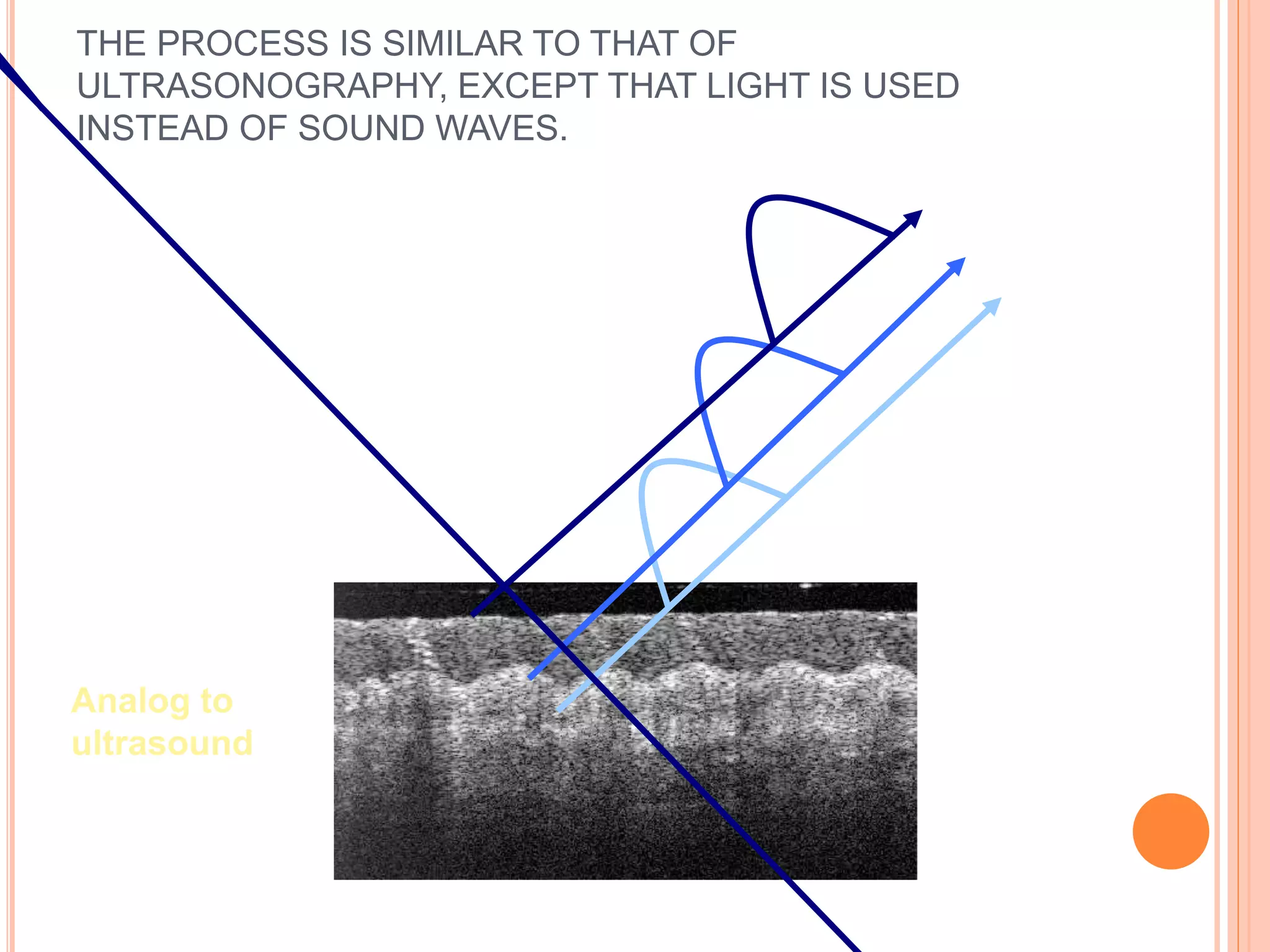 THE PROCESS IS SIMILAR TO THAT OF
ULTRASONOGRAPHY, EXCEPT THAT LIGHT IS USED
INSTEAD OF SOUND WAVES.
Analog to
ultrasound
 