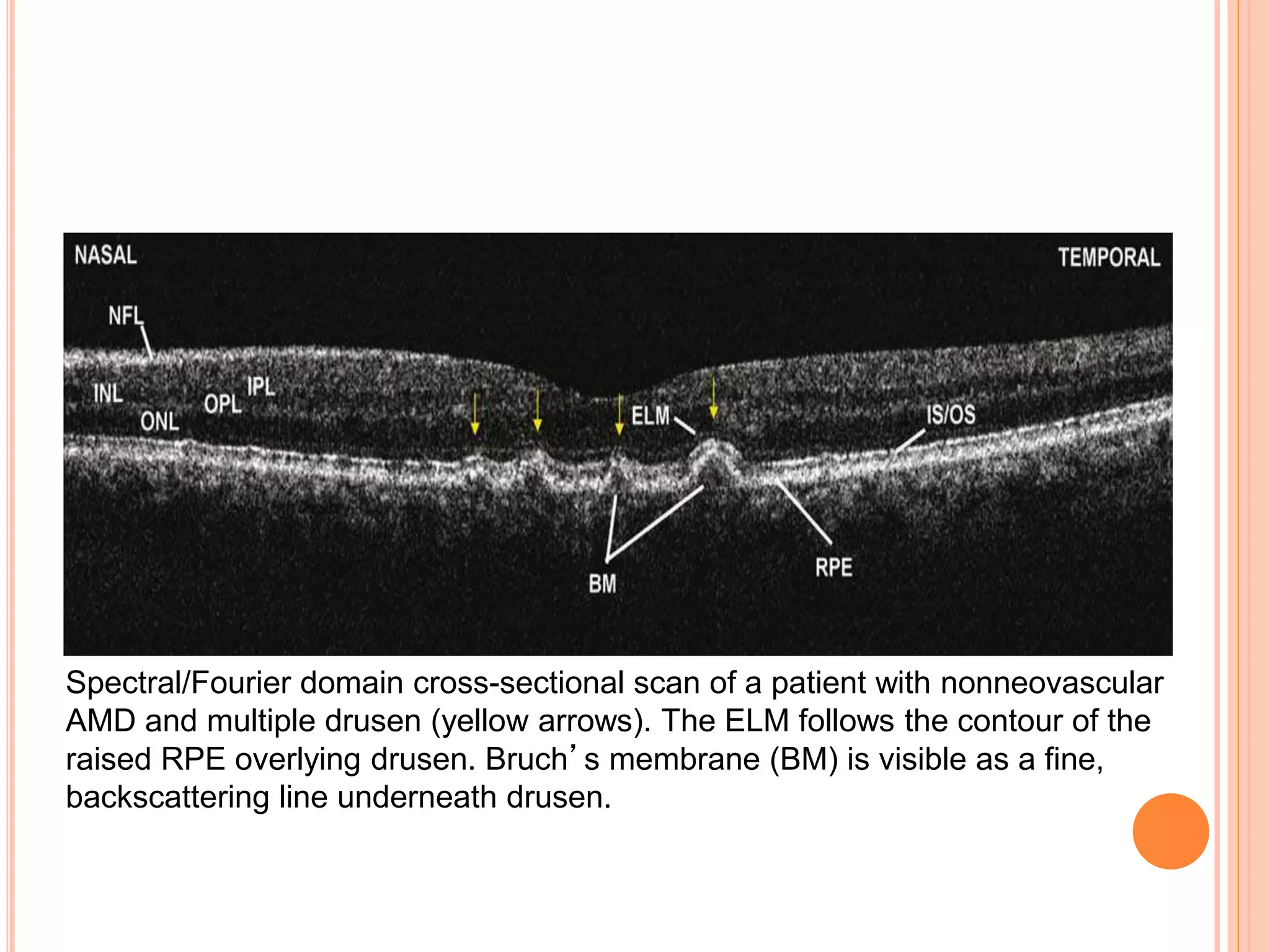 Spectral/Fourier domain cross-sectional scan of a patient with nonneovascular
AMD and multiple drusen (yellow arrows). The ELM follows the contour of the
raised RPE overlying drusen. Bruch’s membrane (BM) is visible as a fine,
backscattering line underneath drusen.
 