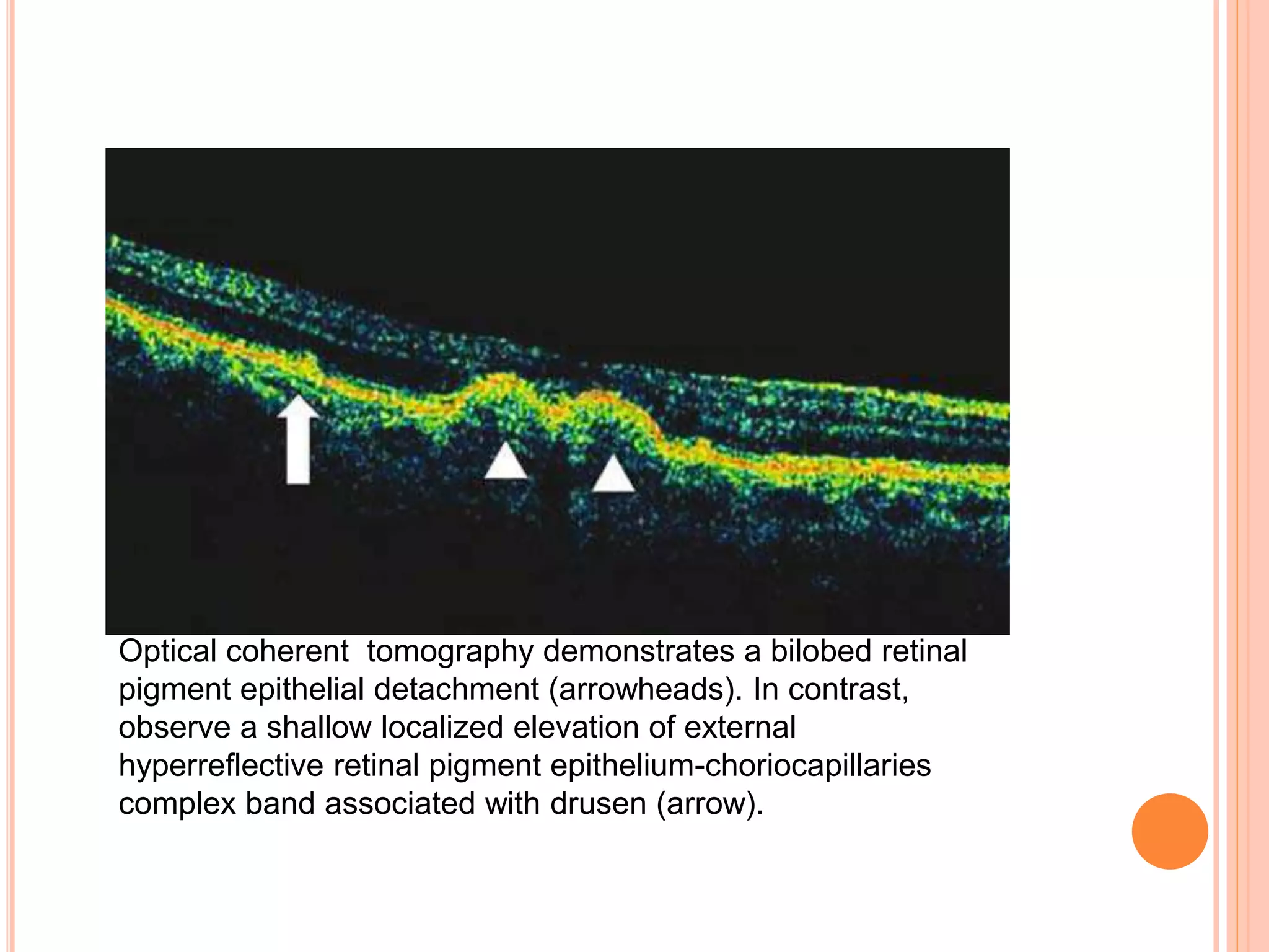 Optical coherent tomography demonstrates a bilobed retinal
pigment epithelial detachment (arrowheads). In contrast,
observe a shallow localized elevation of external
hyperreflective retinal pigment epithelium-choriocapillaries
complex band associated with drusen (arrow).
 
