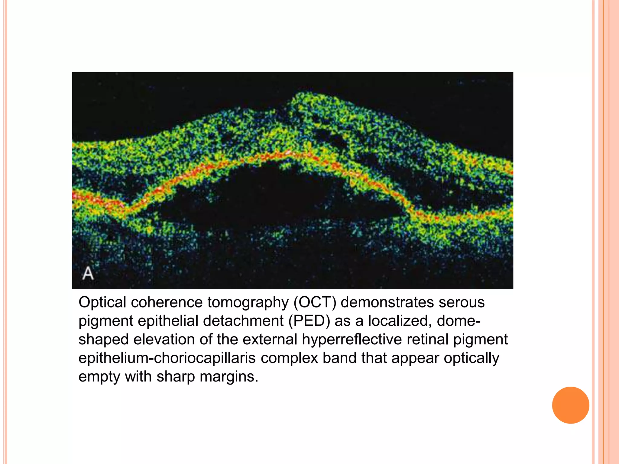 Optical coherence tomography (OCT) demonstrates serous
pigment epithelial detachment (PED) as a localized, dome-
shaped elevation of the external hyperreflective retinal pigment
epithelium-choriocapillaris complex band that appear optically
empty with sharp margins.
 