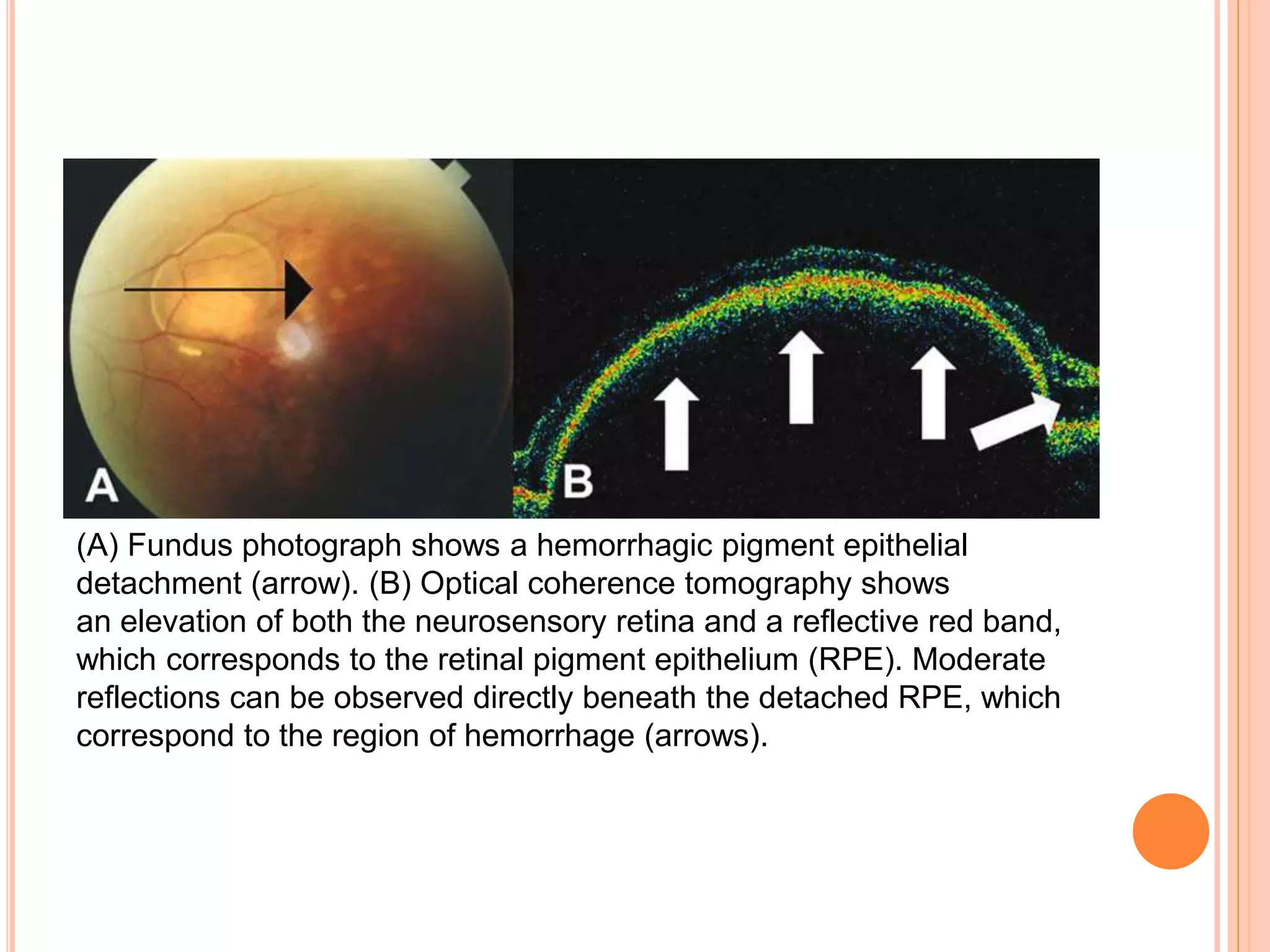 (A) Fundus photograph shows a hemorrhagic pigment epithelial
detachment (arrow). (B) Optical coherence tomography shows
an elevation of both the neurosensory retina and a reflective red band,
which corresponds to the retinal pigment epithelium (RPE). Moderate
reflections can be observed directly beneath the detached RPE, which
correspond to the region of hemorrhage (arrows).
 