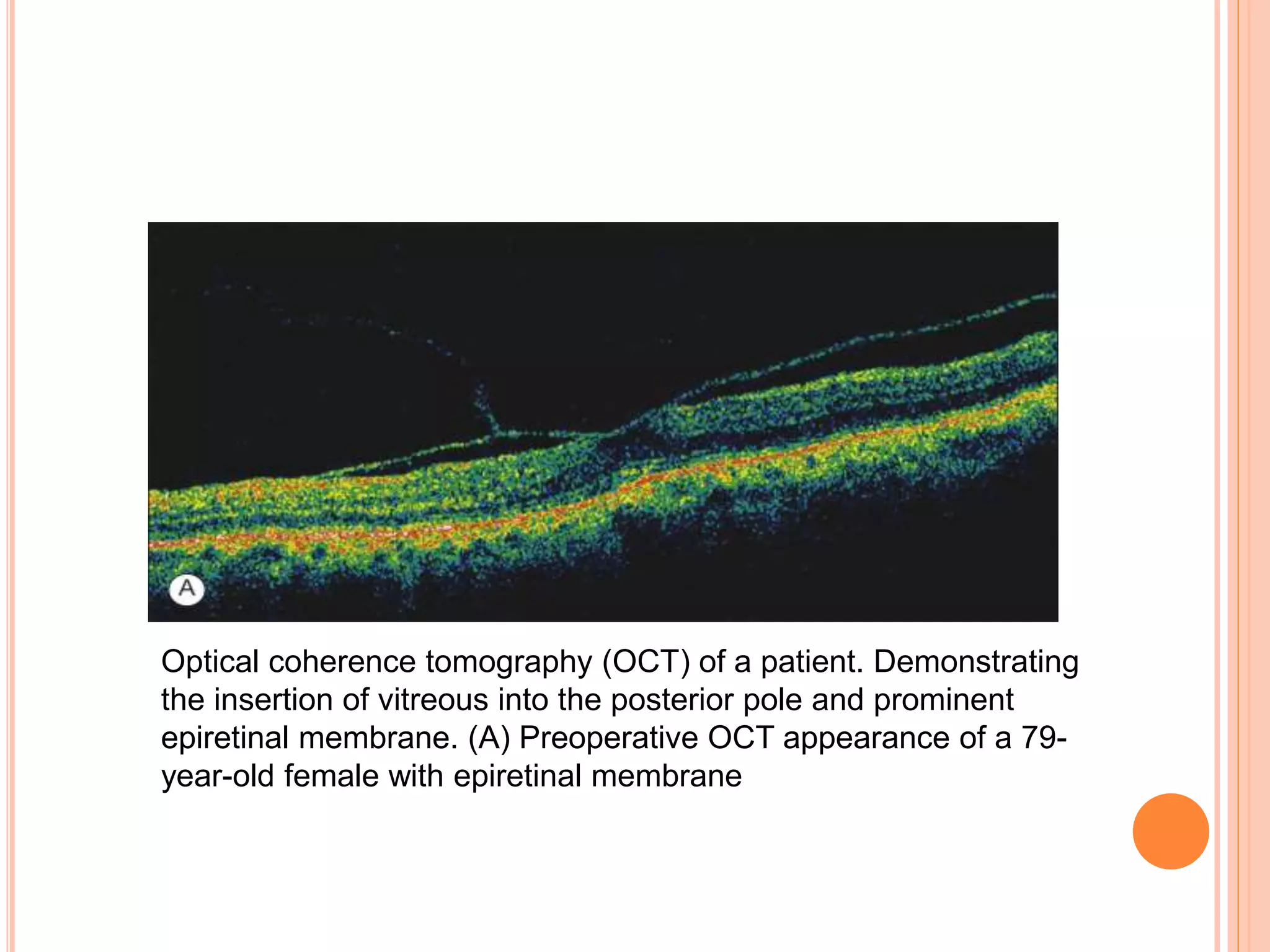 Optical coherence tomography (OCT) of a patient. Demonstrating
the insertion of vitreous into the posterior pole and prominent
epiretinal membrane. (A) Preoperative OCT appearance of a 79-
year-old female with epiretinal membrane
 