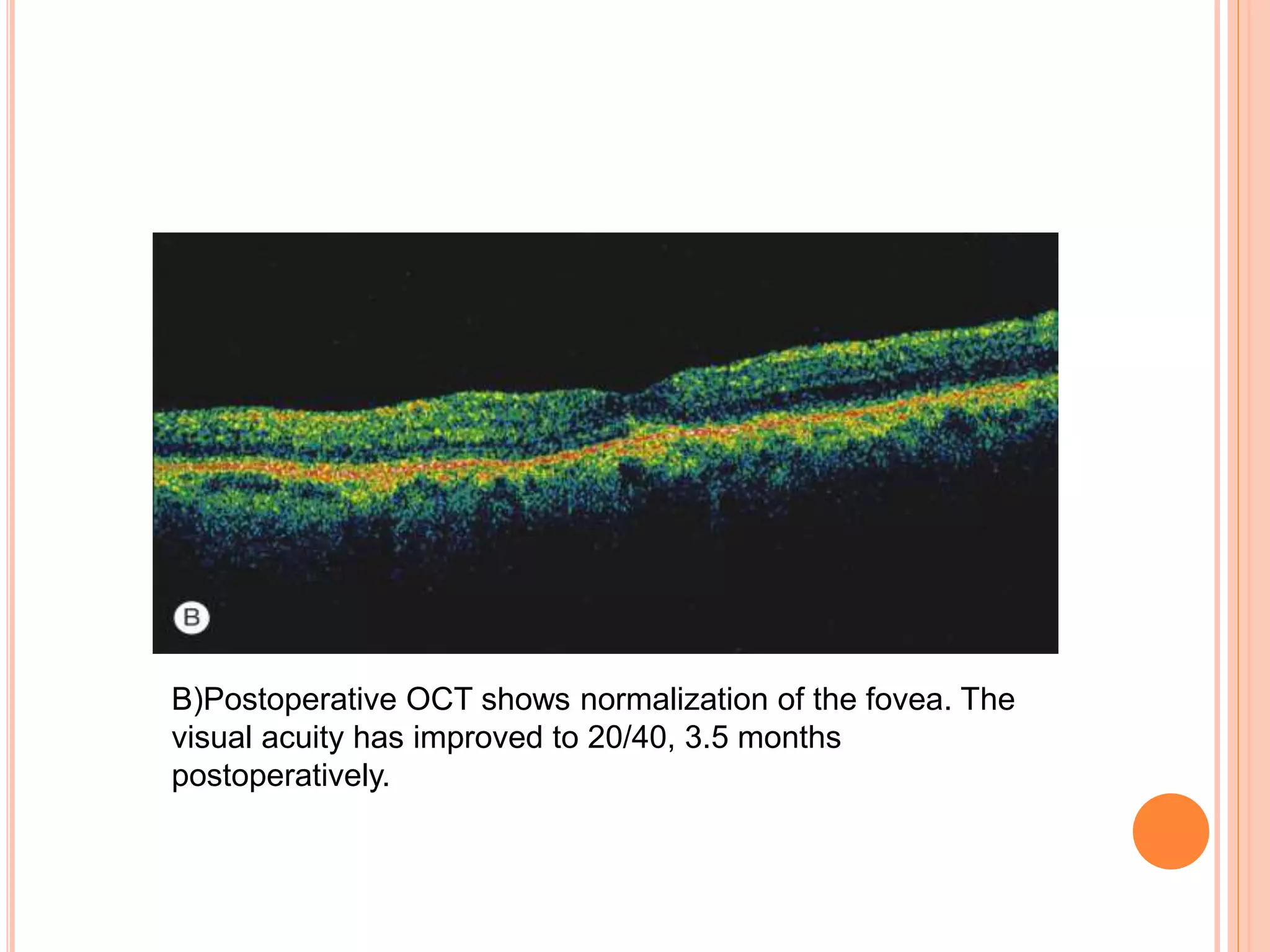 B)Postoperative OCT shows normalization of the fovea. The
visual acuity has improved to 20/40, 3.5 months
postoperatively.
 
