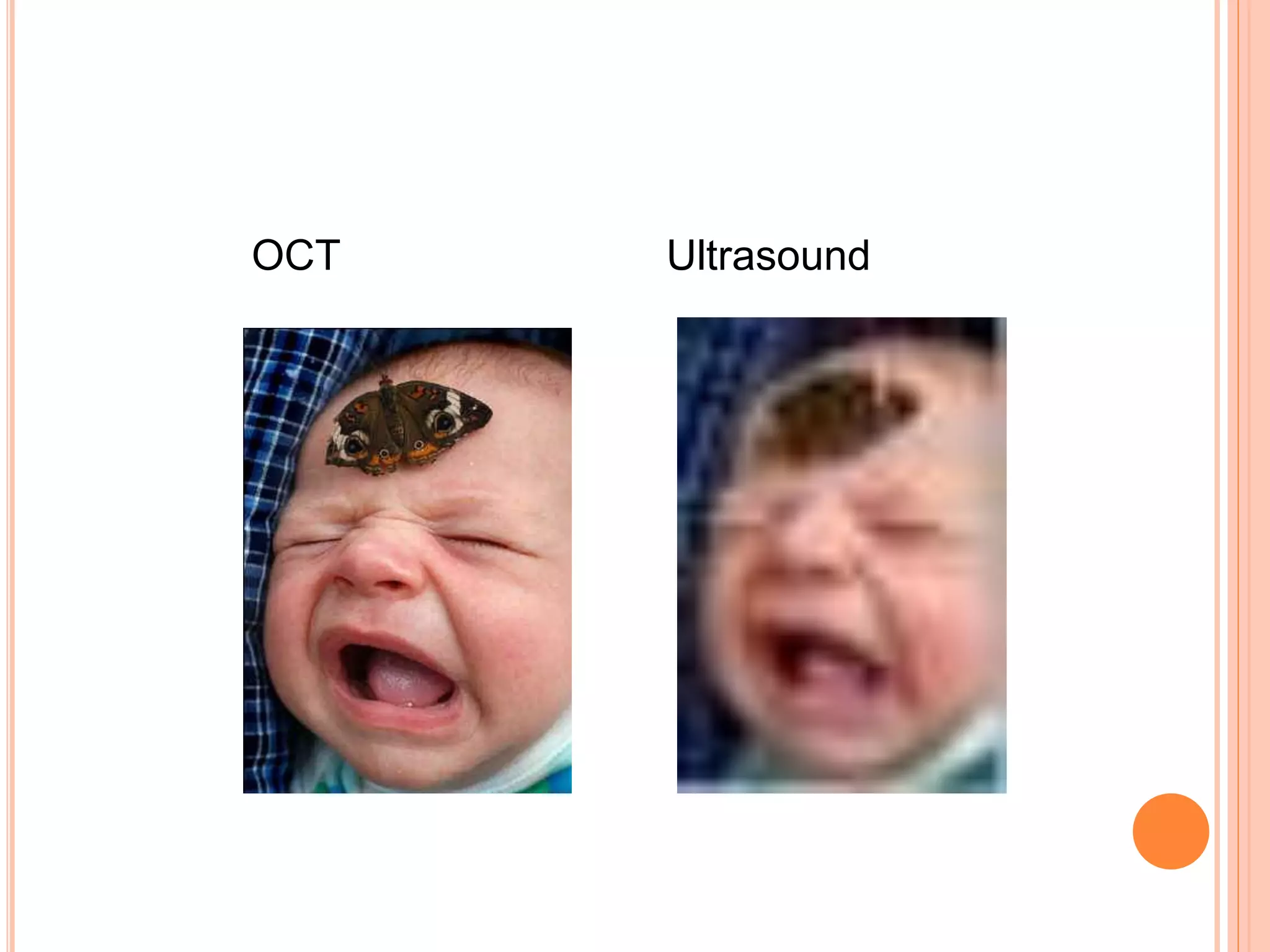 OCT Ultrasound
 