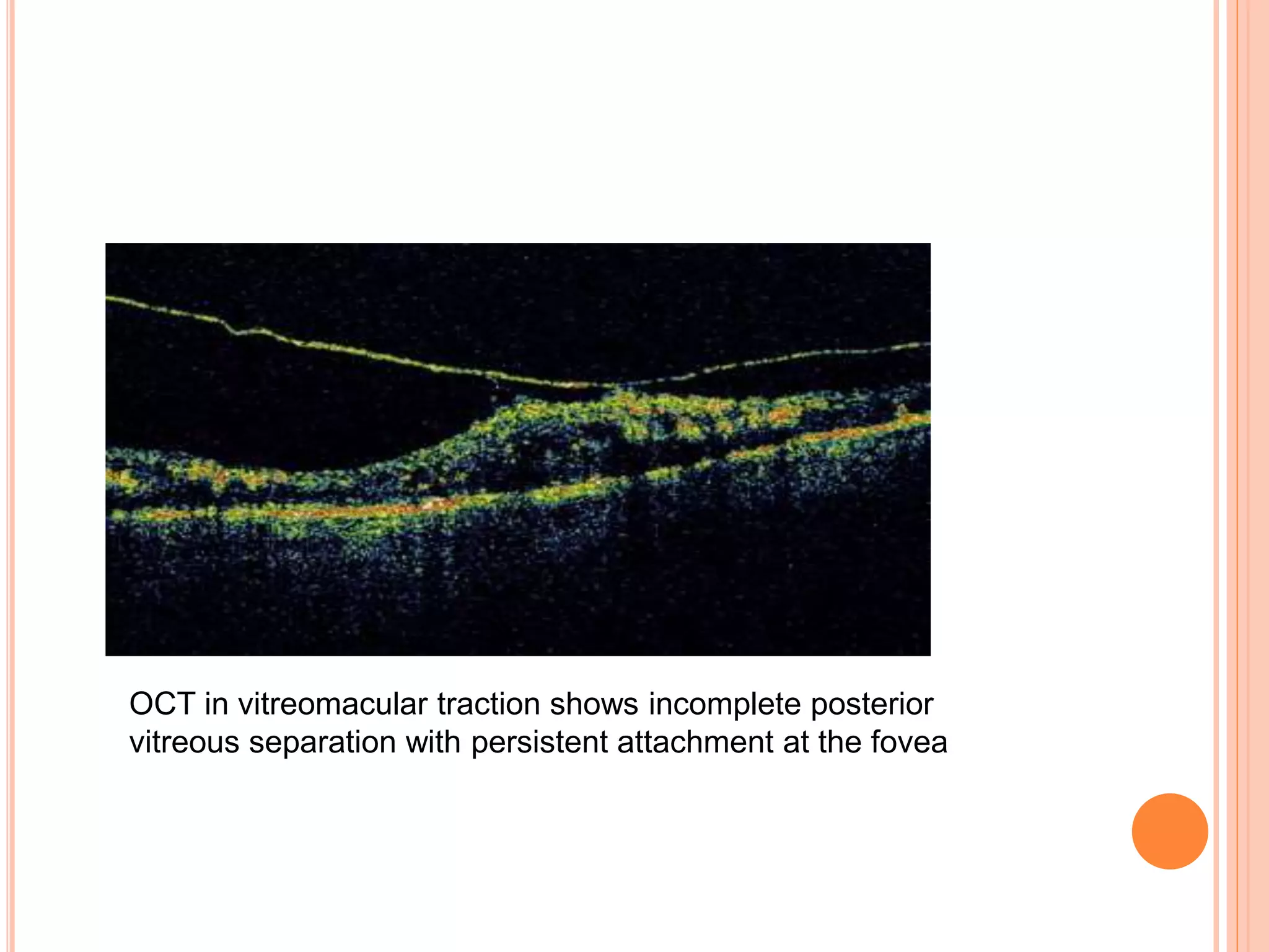OCT in vitreomacular traction shows incomplete posterior
vitreous separation with persistent attachment at the fovea
 
