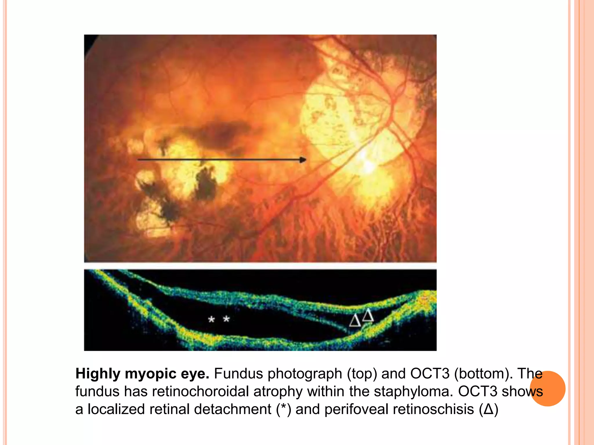 Highly myopic eye. Fundus photograph (top) and OCT3 (bottom). The
fundus has retinochoroidal atrophy within the staphyloma. OCT3 shows
a localized retinal detachment (*) and perifoveal retinoschisis (Δ)
 