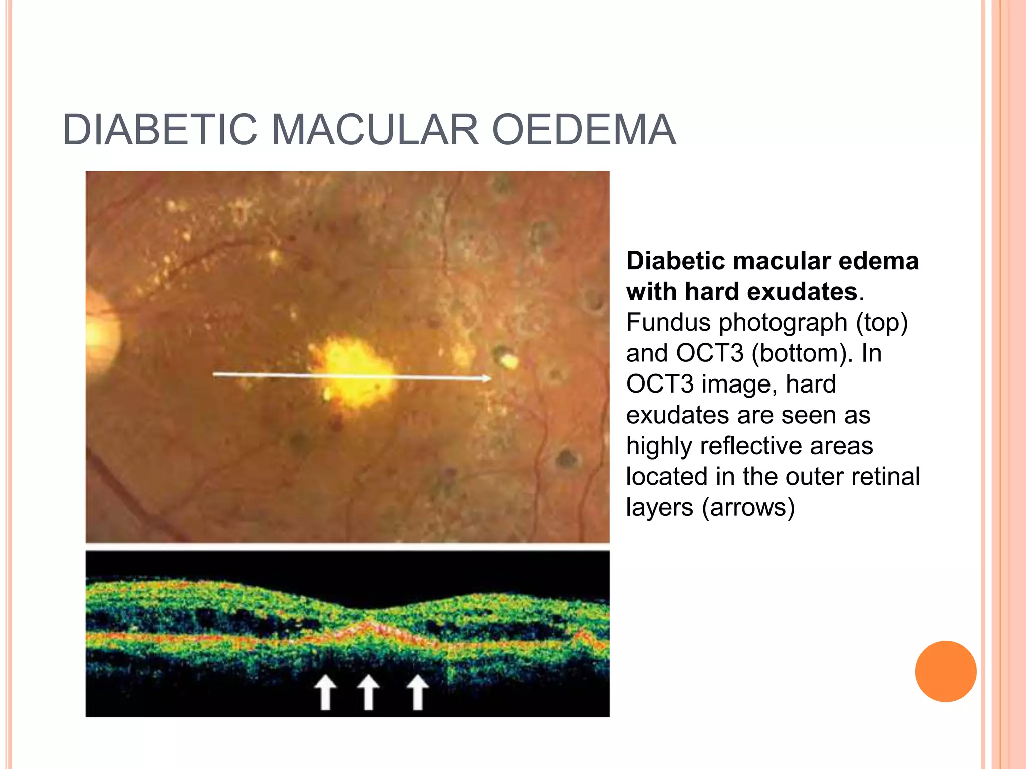 DIABETIC MACULAR OEDEMA
Diabetic macular edema
with hard exudates.
Fundus photograph (top)
and OCT3 (bottom). In
OCT3 image, hard
exudates are seen as
highly reflective areas
located in the outer retinal
layers (arrows)
 