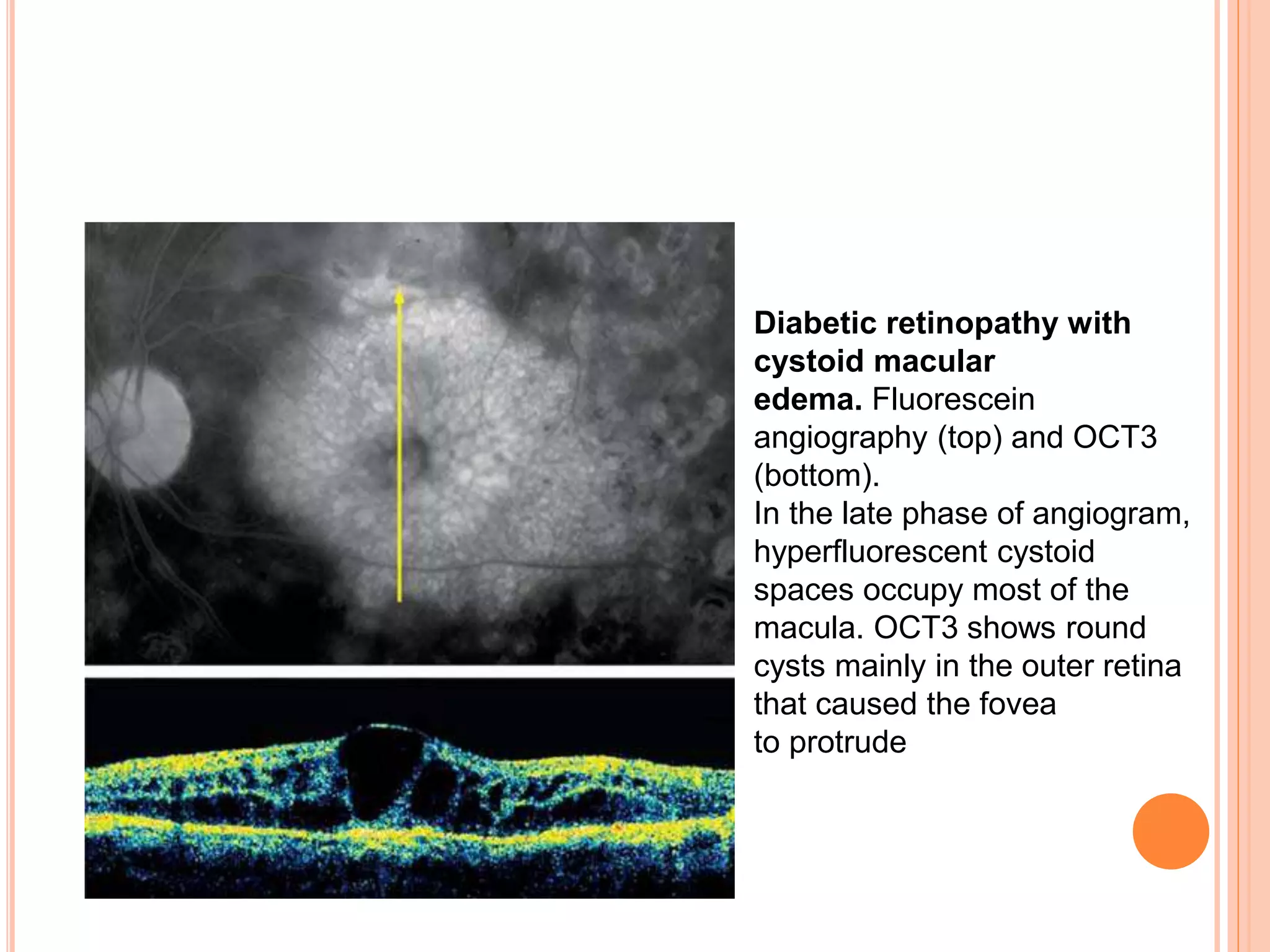 Diabetic retinopathy with
cystoid macular
edema. Fluorescein
angiography (top) and OCT3
(bottom).
In the late phase of angiogram,
hyperfluorescent cystoid
spaces occupy most of the
macula. OCT3 shows round
cysts mainly in the outer retina
that caused the fovea
to protrude
 