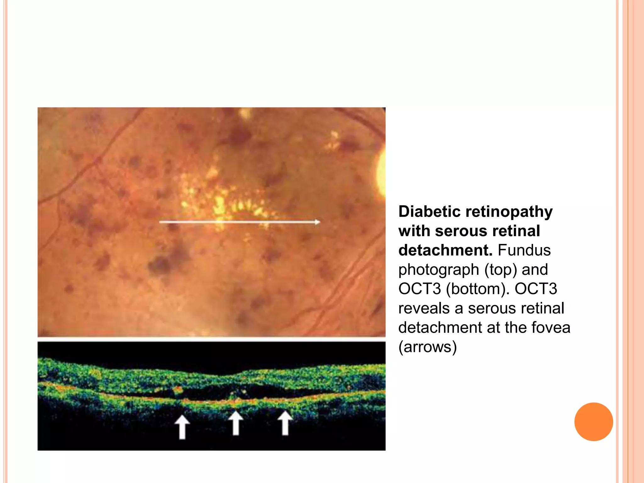 Diabetic retinopathy
with serous retinal
detachment. Fundus
photograph (top) and
OCT3 (bottom). OCT3
reveals a serous retinal
detachment at the fovea
(arrows)
 