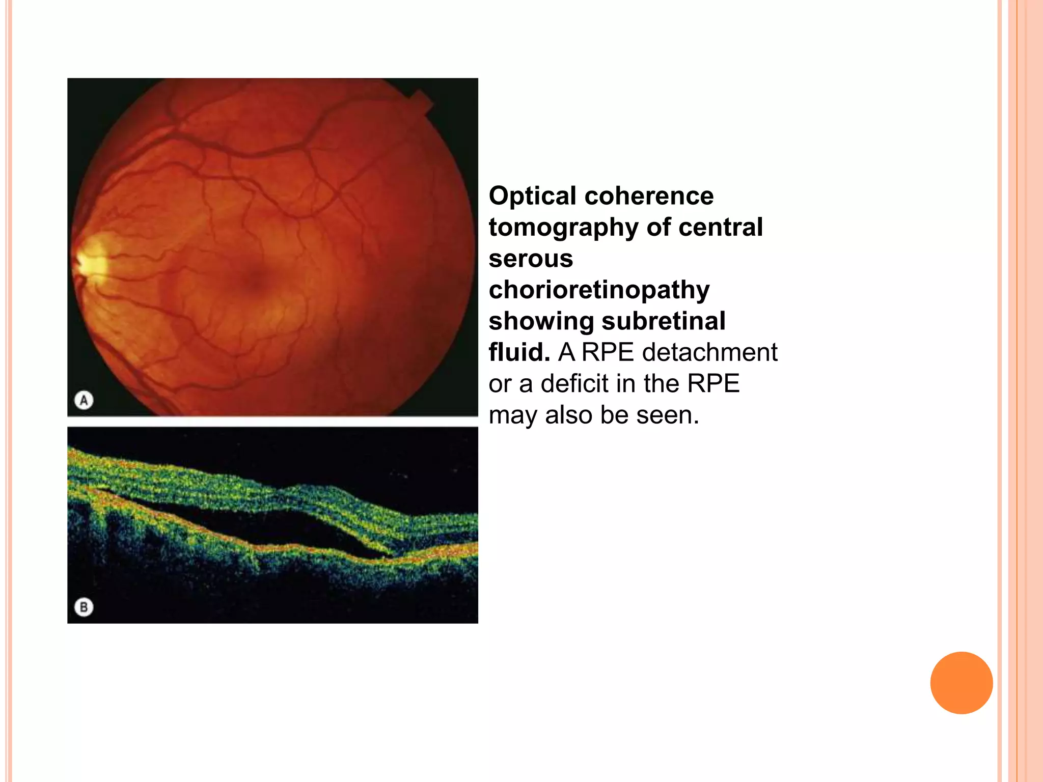 Optical coherence
tomography of central
serous
chorioretinopathy
showing subretinal
fluid. A RPE detachment
or a deficit in the RPE
may also be seen.
 