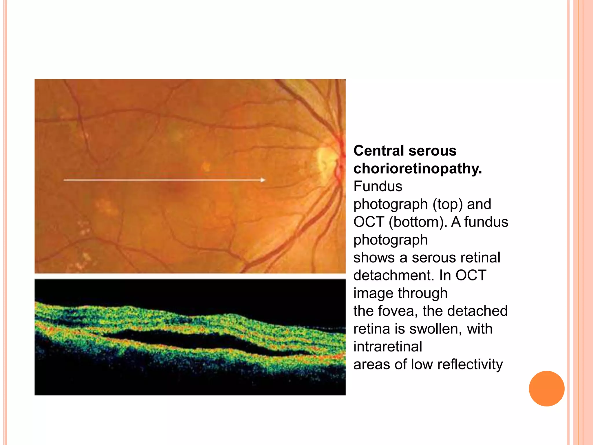Central serous
chorioretinopathy.
Fundus
photograph (top) and
OCT (bottom). A fundus
photograph
shows a serous retinal
detachment. In OCT
image through
the fovea, the detached
retina is swollen, with
intraretinal
areas of low reflectivity
 