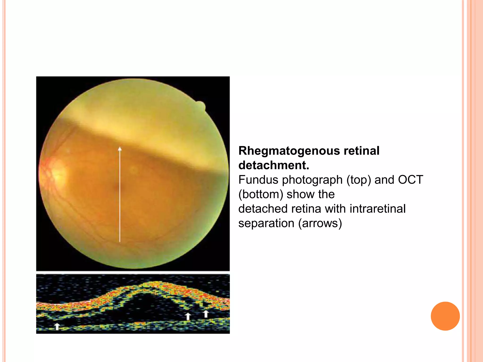 Rhegmatogenous retinal
detachment.
Fundus photograph (top) and OCT
(bottom) show the
detached retina with intraretinal
separation (arrows)
 