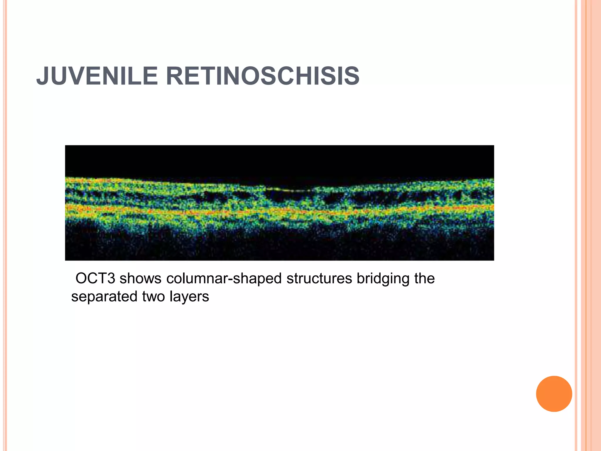 JUVENILE RETINOSCHISIS
OCT3 shows columnar-shaped structures bridging the
separated two layers
 