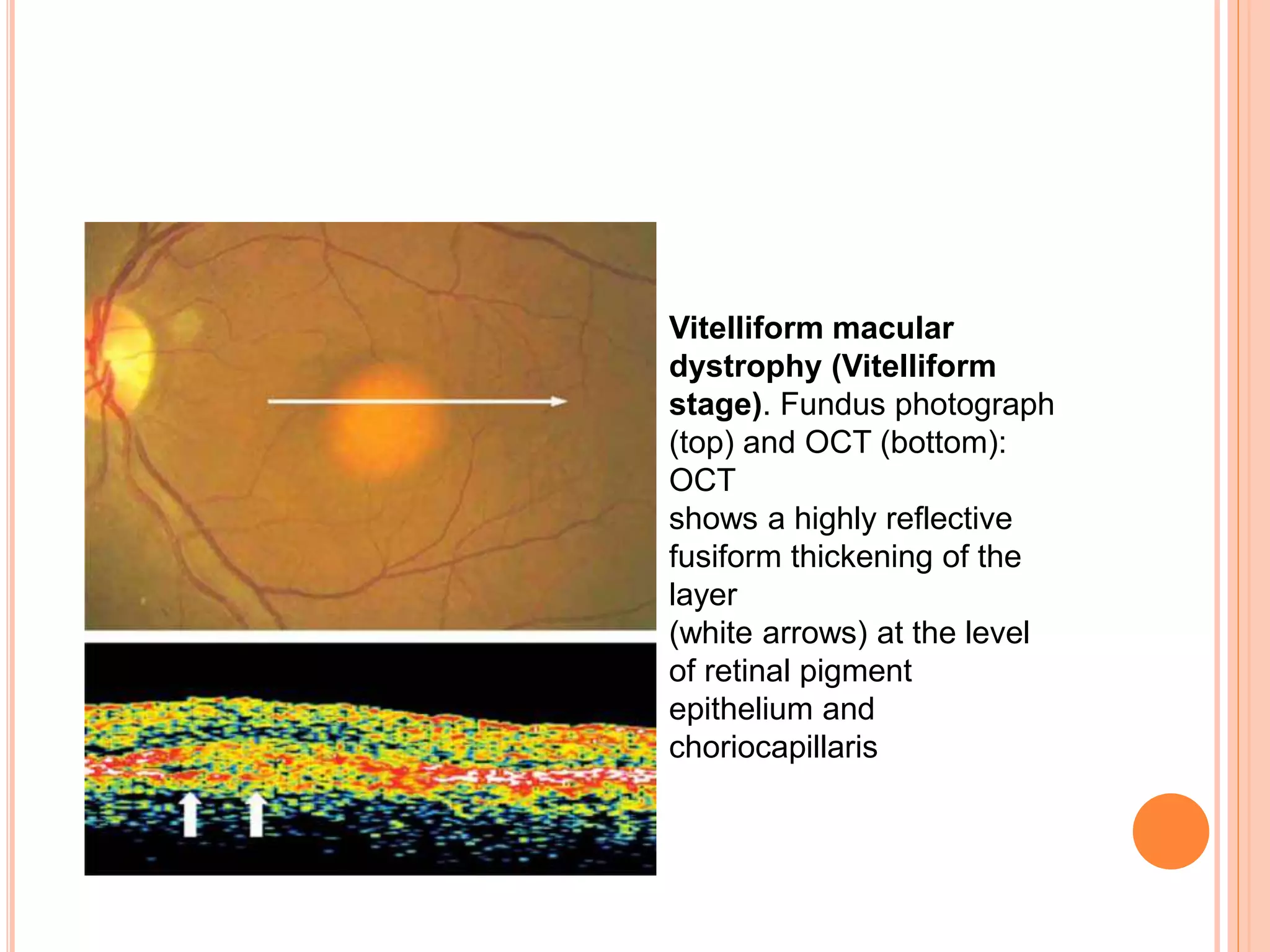 Vitelliform macular
dystrophy (Vitelliform
stage). Fundus photograph
(top) and OCT (bottom):
OCT
shows a highly reflective
fusiform thickening of the
layer
(white arrows) at the level
of retinal pigment
epithelium and
choriocapillaris
 